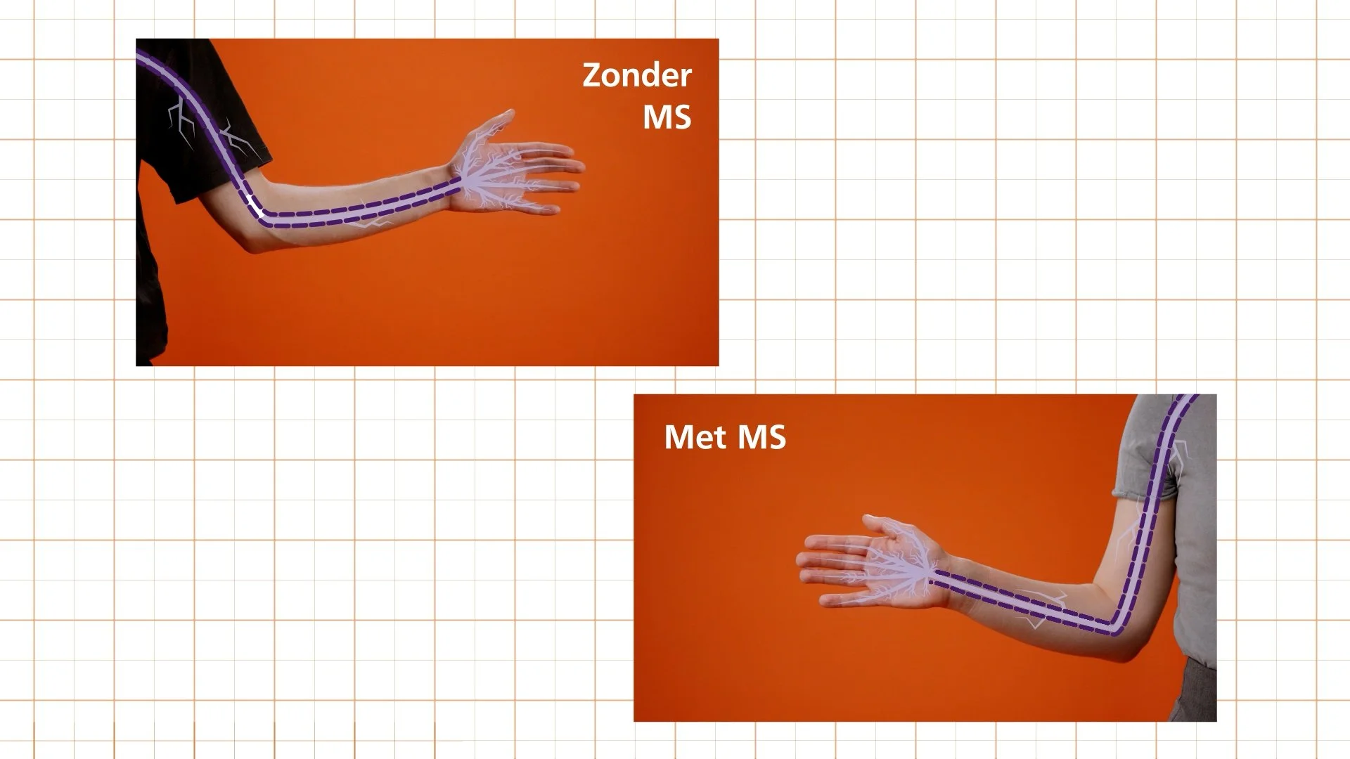 35450_NMSF_Astrocyten_Zonder MS met MS.jpg