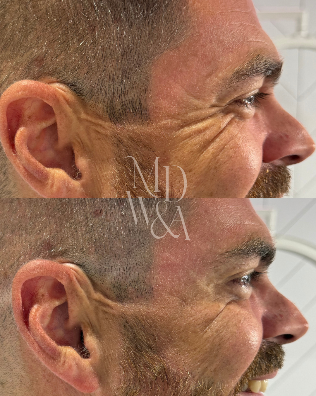 mike before.after 2.png