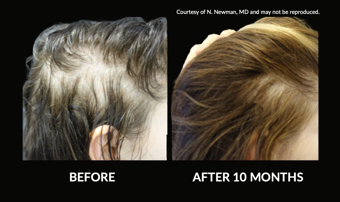 Comparison of a woman's scalp showing hair loss before and hair regrowth after 10 months of treatment, with the left side labeled "BEFORE" and the right side labeled "AFTER 10 MONTHS."