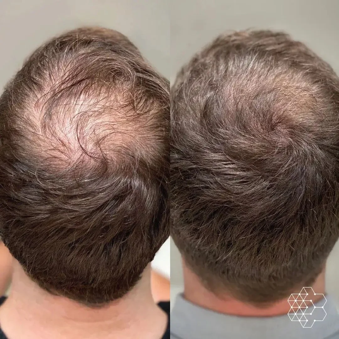 A side-by-side comparison of a person's scalp showing before and after hair restoration or treatment, with the left side displaying thinning hair and the right side showing fuller hair.
