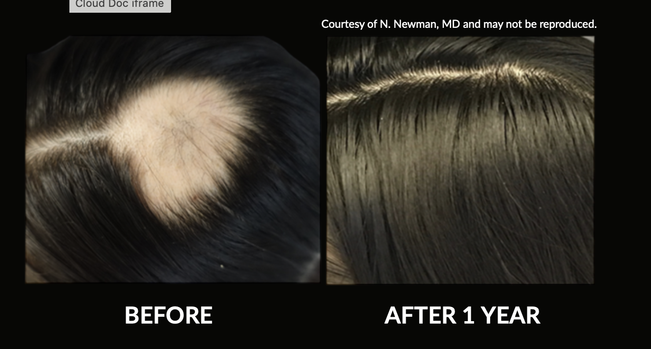 Comparison of a person's scalp showing hair loss before and hair regrowth after one year of treatment, with a visible increase in hair density and coverage.