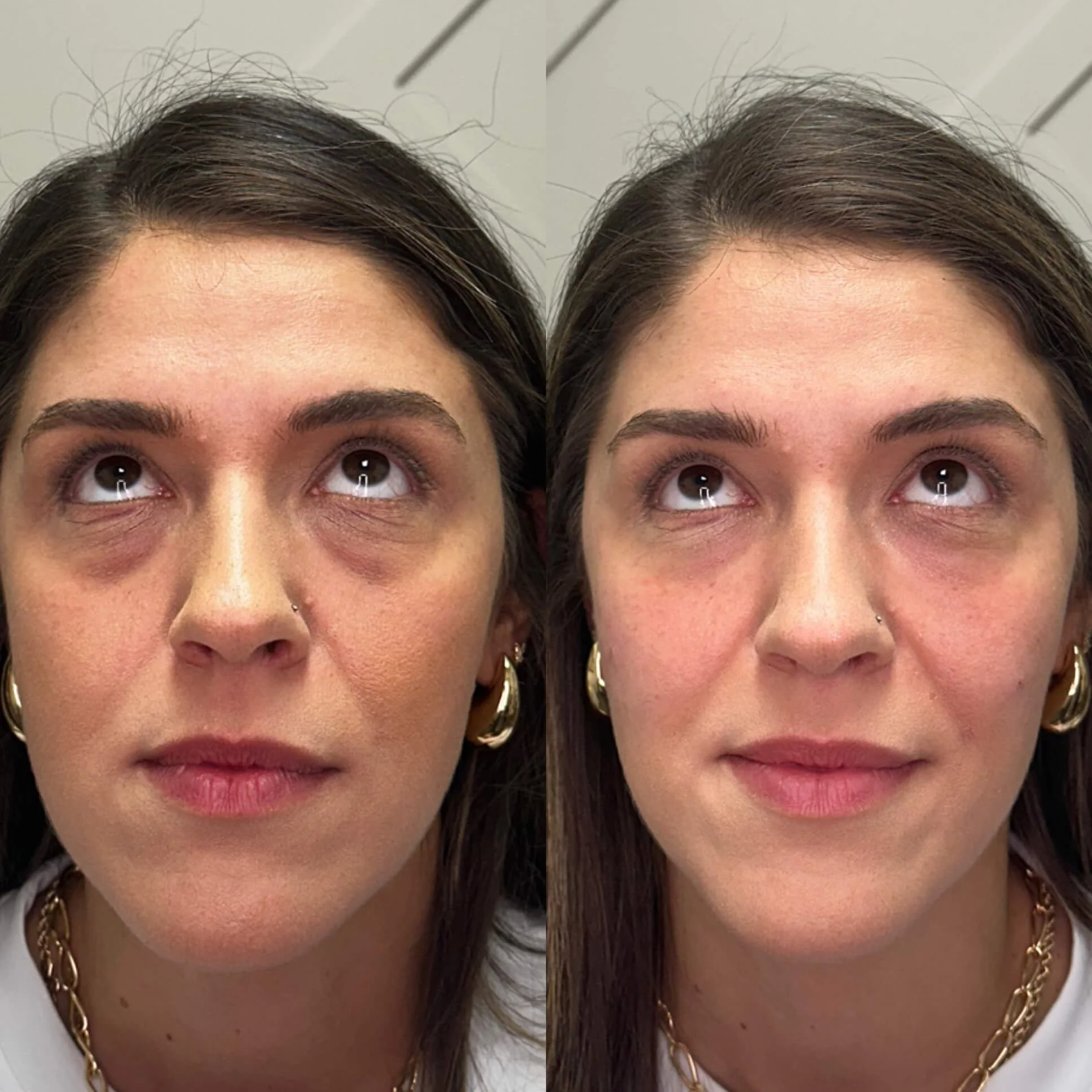  Restylane filler before and after 