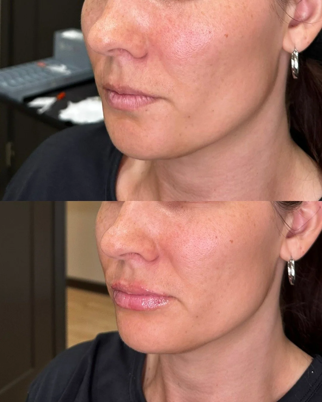 Proof that subtle can still make a statement 💁🏼&zwj;♀️

A little filler can do wonders for someone's confidence! Come get your filler with The Glow Lab today! 📞 480-771-7202

#lips #gilbertinjectables #gilbertsmallbusiness #lipfiller #botox #gilbe
