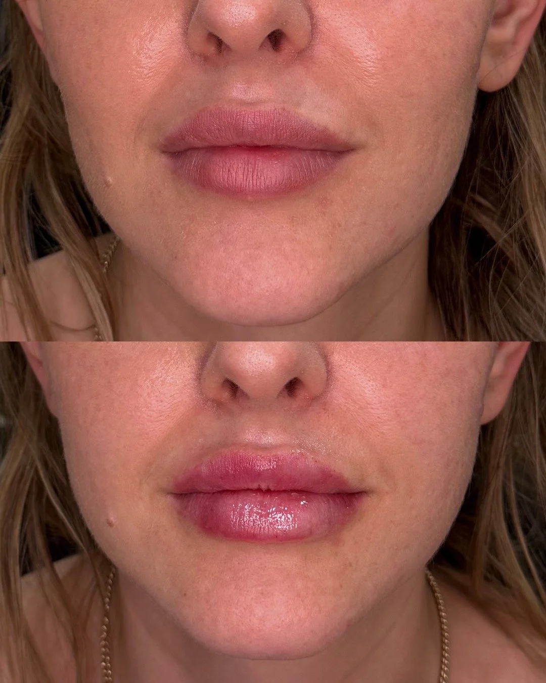 ✨ Subtle Enhancement, Beautiful Results ✨

Transform your look with our Lip Filler treatment! Perfect for adding natural volume and hydration, leaving your lips looking plump and gorgeous 🤩 Call 480-771-7202 or book online to get this transformation