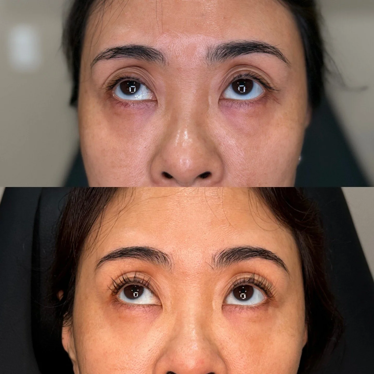 Small change ➡️ big difference

Your body knows best 💉 PRF uses your own platelets to restore volume, boost collagen &amp; refresh the delicate under-eye area!

📞 480-771-7202
📍The Glow Lab
  Gilbert, AZ 

#PRF #undereyes #gilbertinjector #filler 