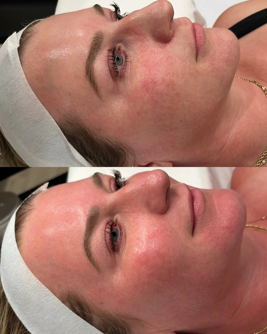 This beautiful client completed a series of 3 microneedling treatments and is glowing 🤩 

Microneedling helps fade pigmentation, reduce fine lines and wrinkles, pore size and acne scars! Come get your corrective treatment now before the holidays!

?