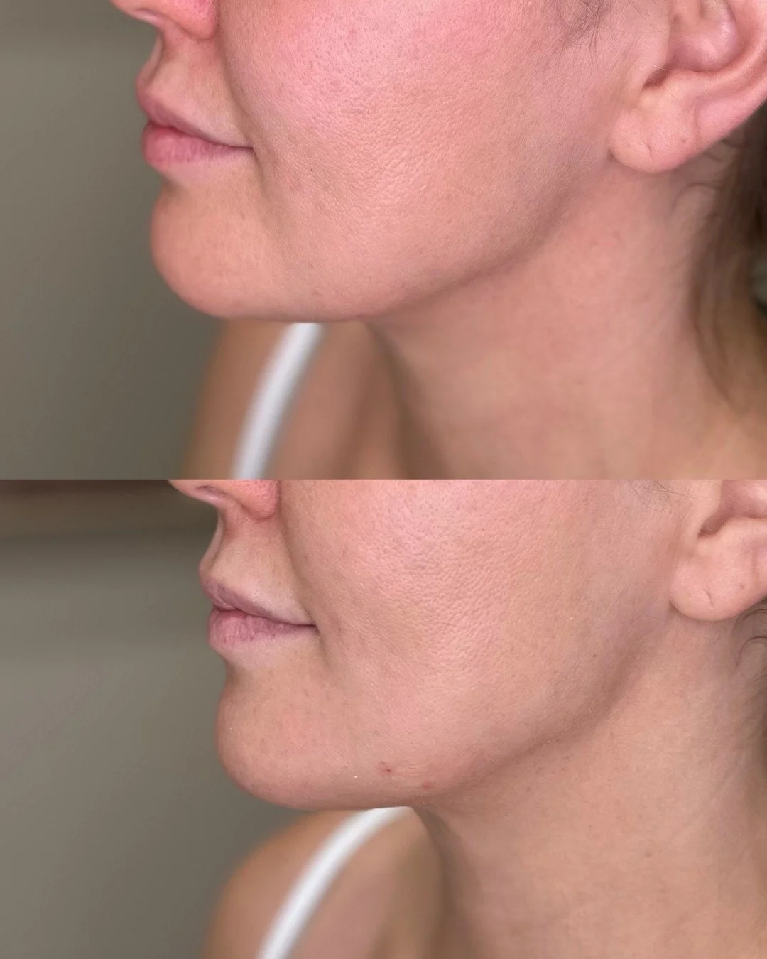 Why chin filler? 👇

✔️ Improves profile balance
✔️ Defines jawline
✔️ Enhances facial harmony

Come get some chin filler with us! 

📞480-771-7202
📍The Glow Lab
  Gilbert, AZ

#facialbalancing #filler #gilbertinjectables #gilbert #smallbusiness #gi