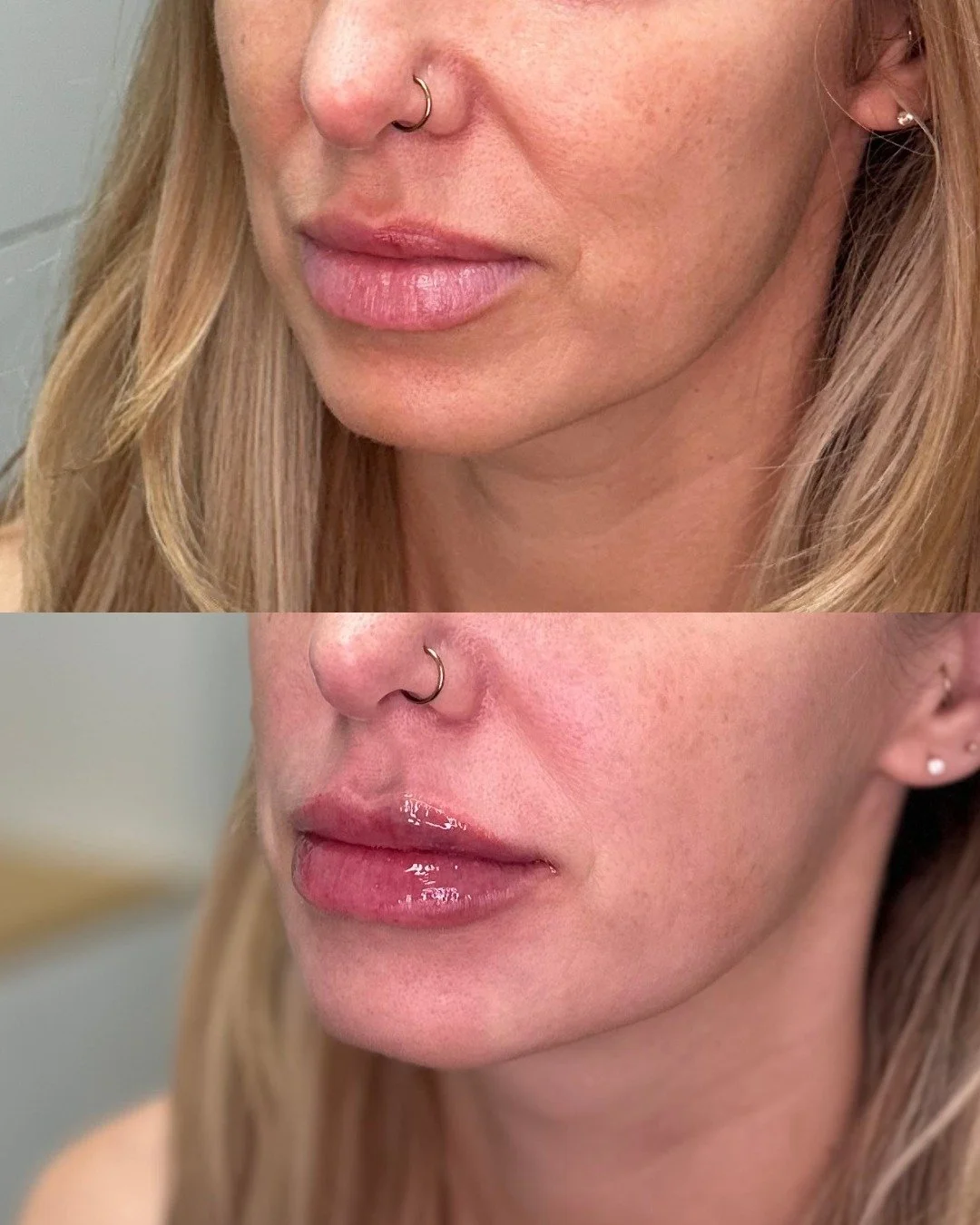 Today's goal: perfect lips! Come to see us for your perfect pout!

📞 480-771-7202
📍The Glow Lab
  Gilbert, AZ 

#gilbertinjector #botox #filler #skincare #gilbert #gilbertinjectables #gilbertaesthetics