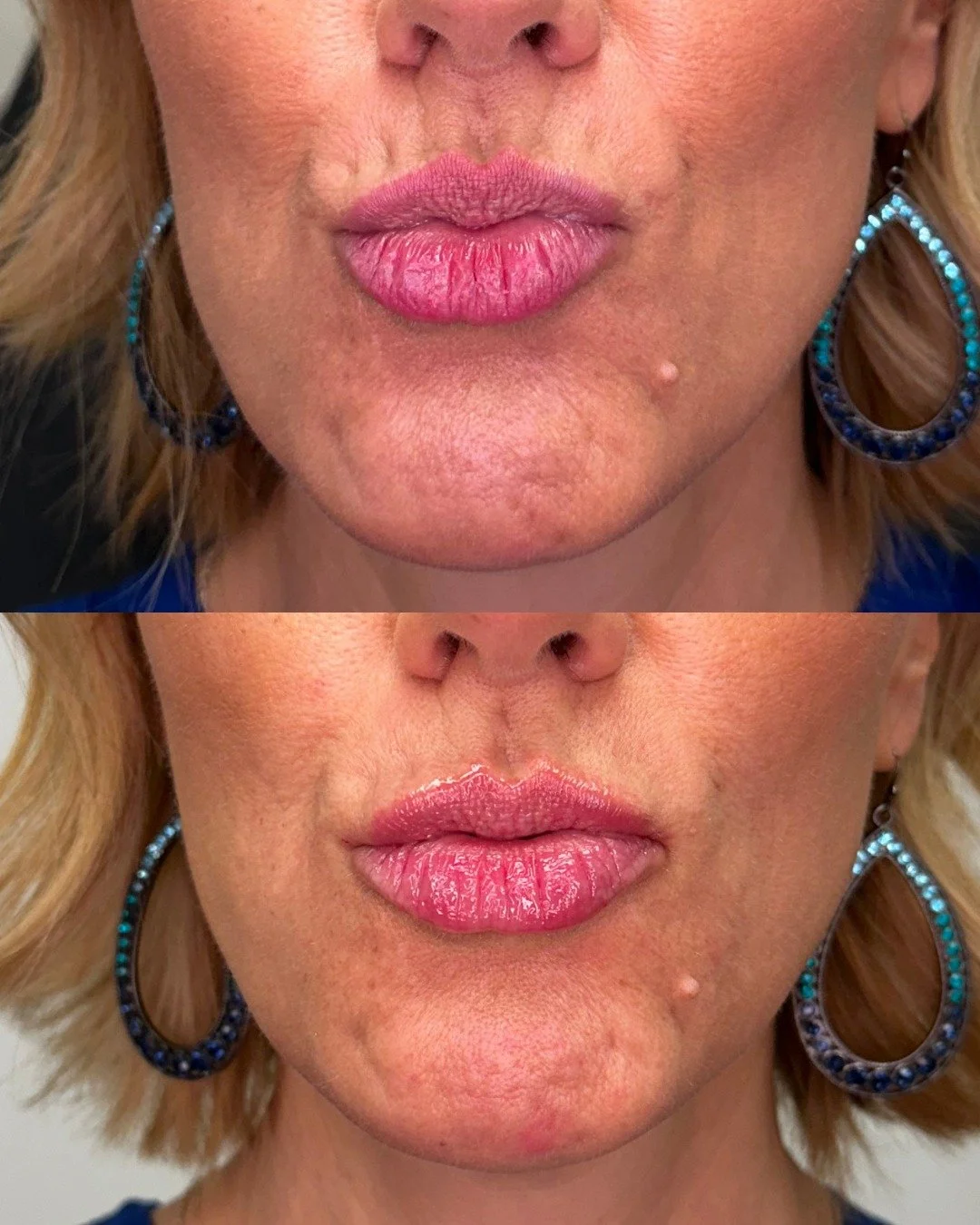 Smoothing threads are designed to stimulate collagen and elastin, smooth lines around the lips and re-support the vermillion border to add a little pop!

Come see us about threads, we love this treatment!

📞 480-771-7202
📍The Glow Lab
  Gilbert, AZ