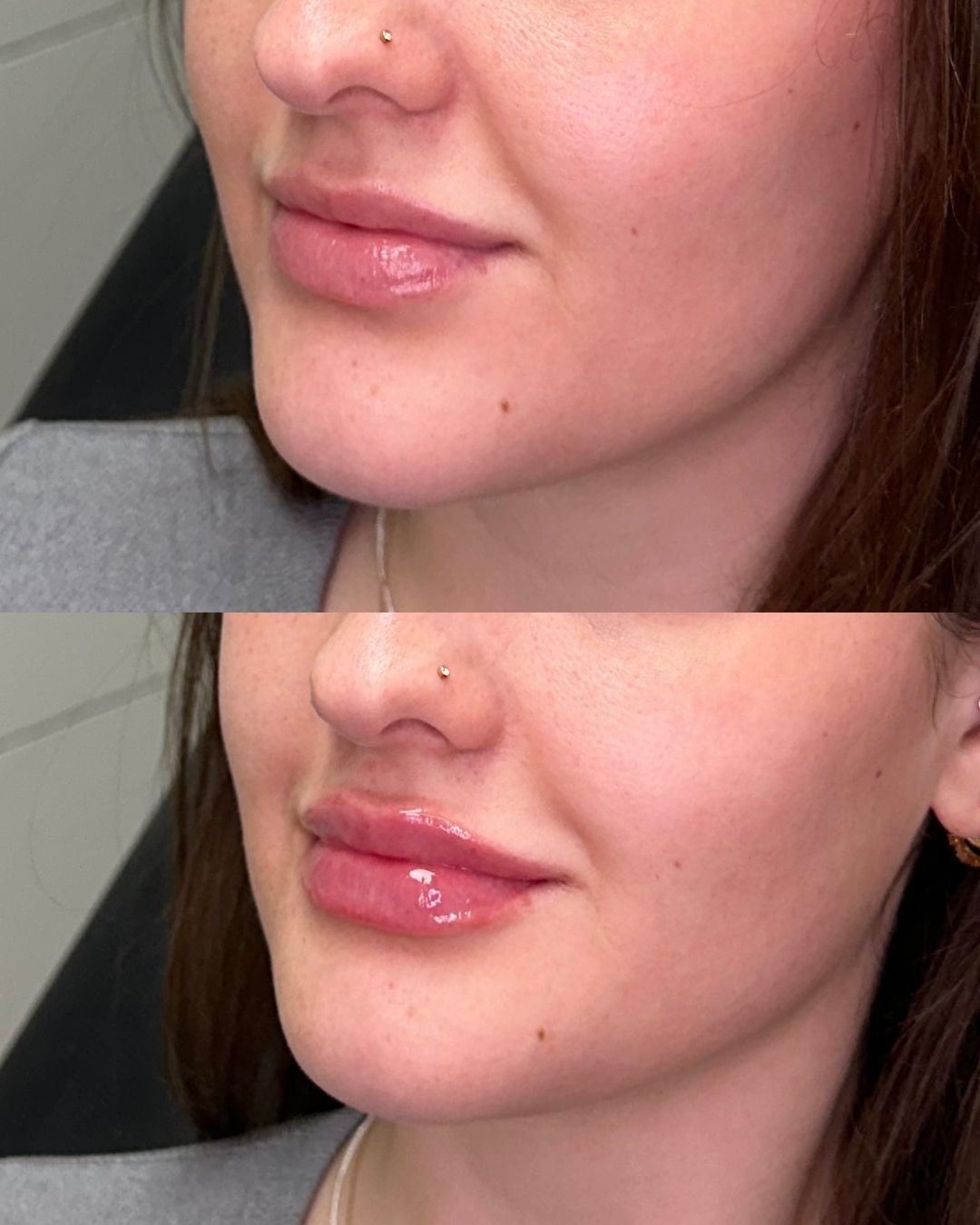 Look at those lips 🤩 What does lip filler do?

✨Adds Volume &rarr; Plumps lips for a fuller look
✨Defines Shape &rarr; Enhances the lip border &amp; cupid&rsquo;s bow
✨Smooths Lines &rarr; Softens &ldquo;lipstick lines&rdquo; or fine wrinkles around