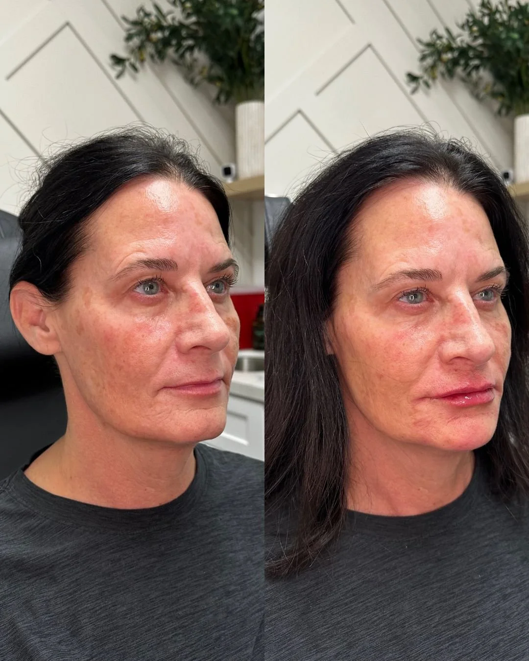 Transformation Tuesday 🤩 

This client did a full face rejuvenation. She did filler in her lips, chin and cheeks for the ultimate lift! Want to get your full face rejuvenation? Give us a call to see what filler is right for you 🎀

📞480-771-7202
📍