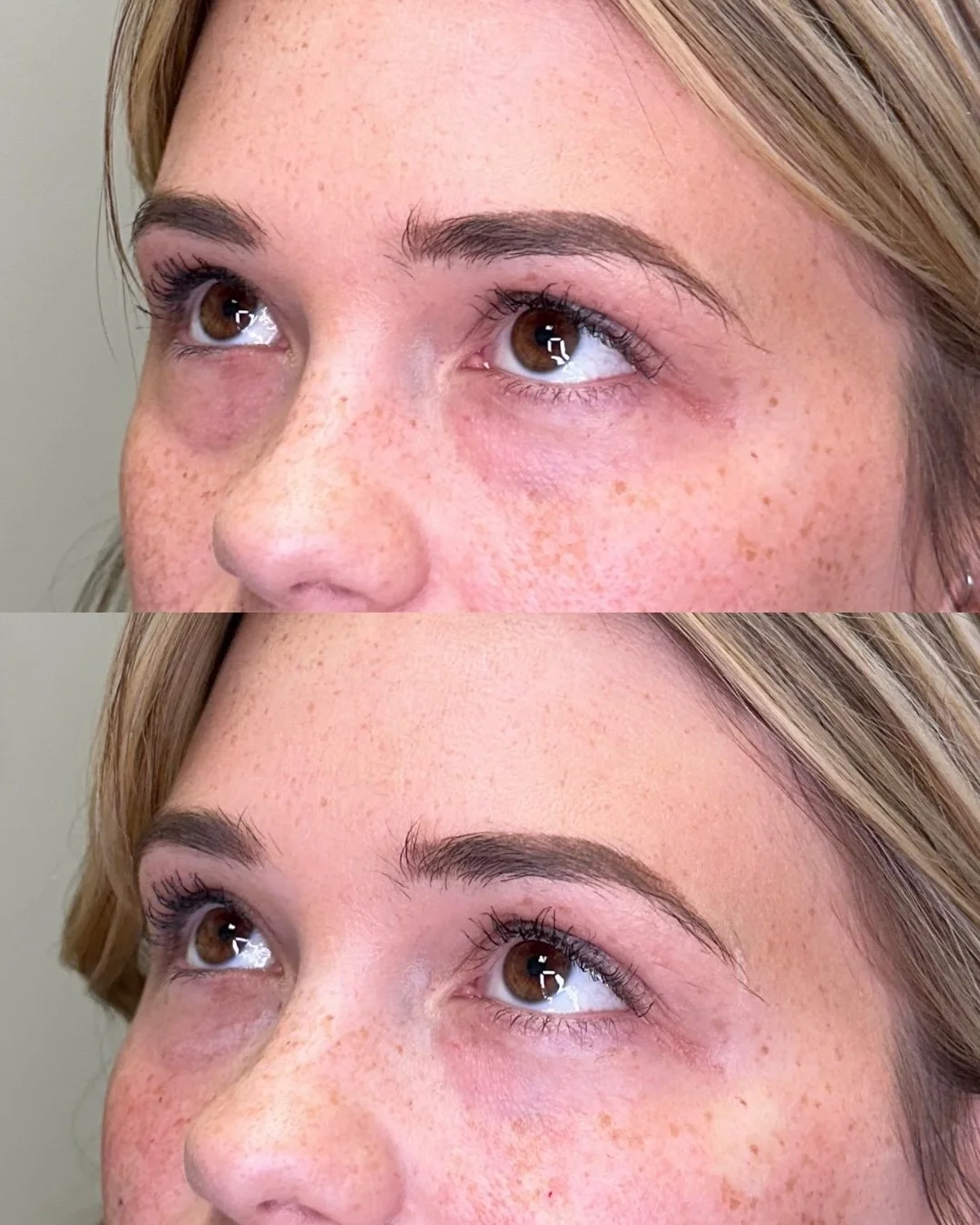 Think of it as your beauty sleep &mdash; in a syringe. 😴✨ 100% natural PRF for under-eye rejuvenation!

This wasn't just any other PRF treatment, this beautiful patient was getting ready for her WEDDING DAY! She wanted that fresh undereye look for h
