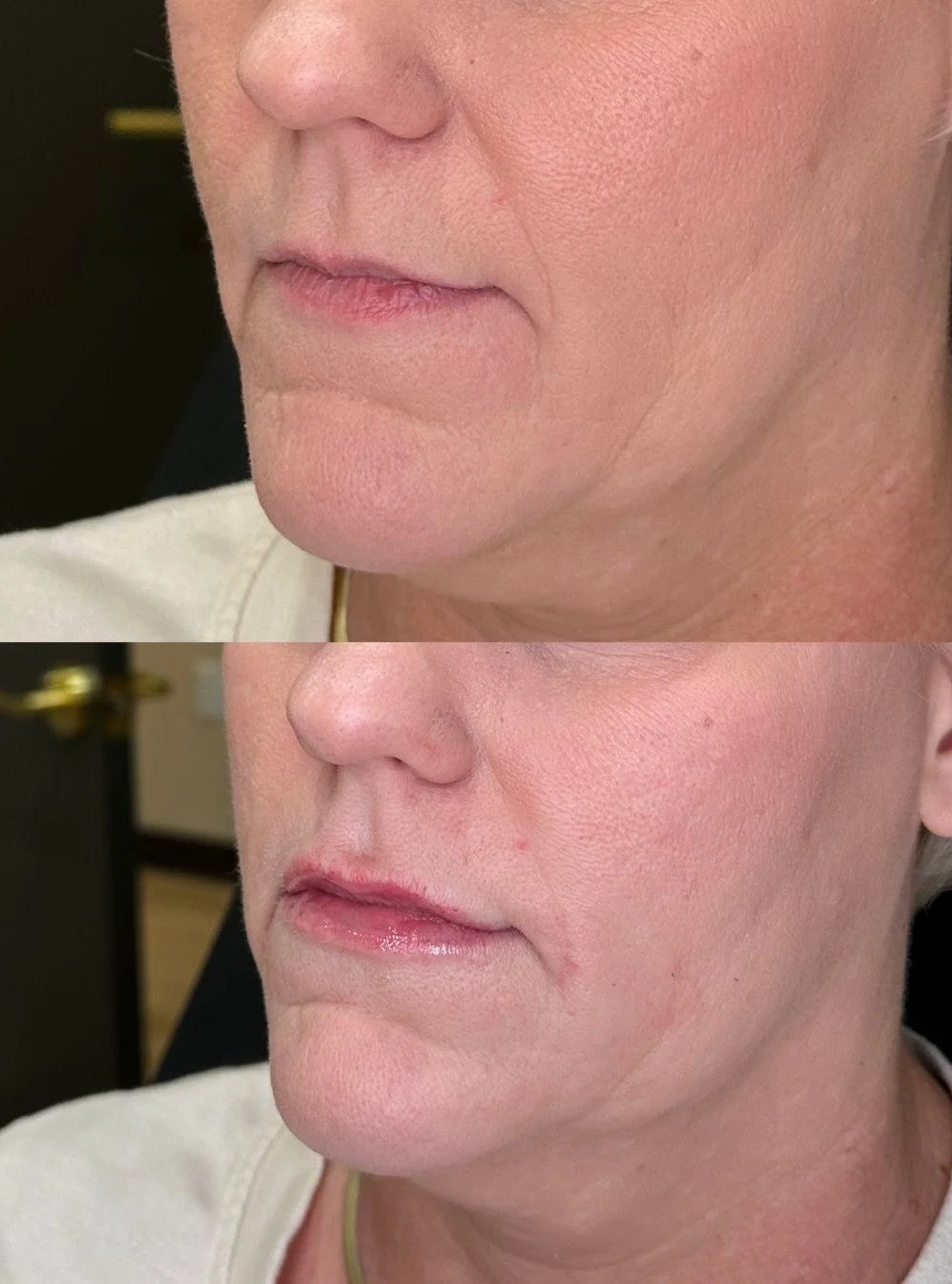 A little filler never hurt 😍 Just subtle changes are what we're here for!

 📞480-771-7202
📍The Glow Lab
  Gilbert, AZ

 #lips #filler #gilbertinjectables #gilbert #smallbusiness #gilbertaesthetics #lipfiller