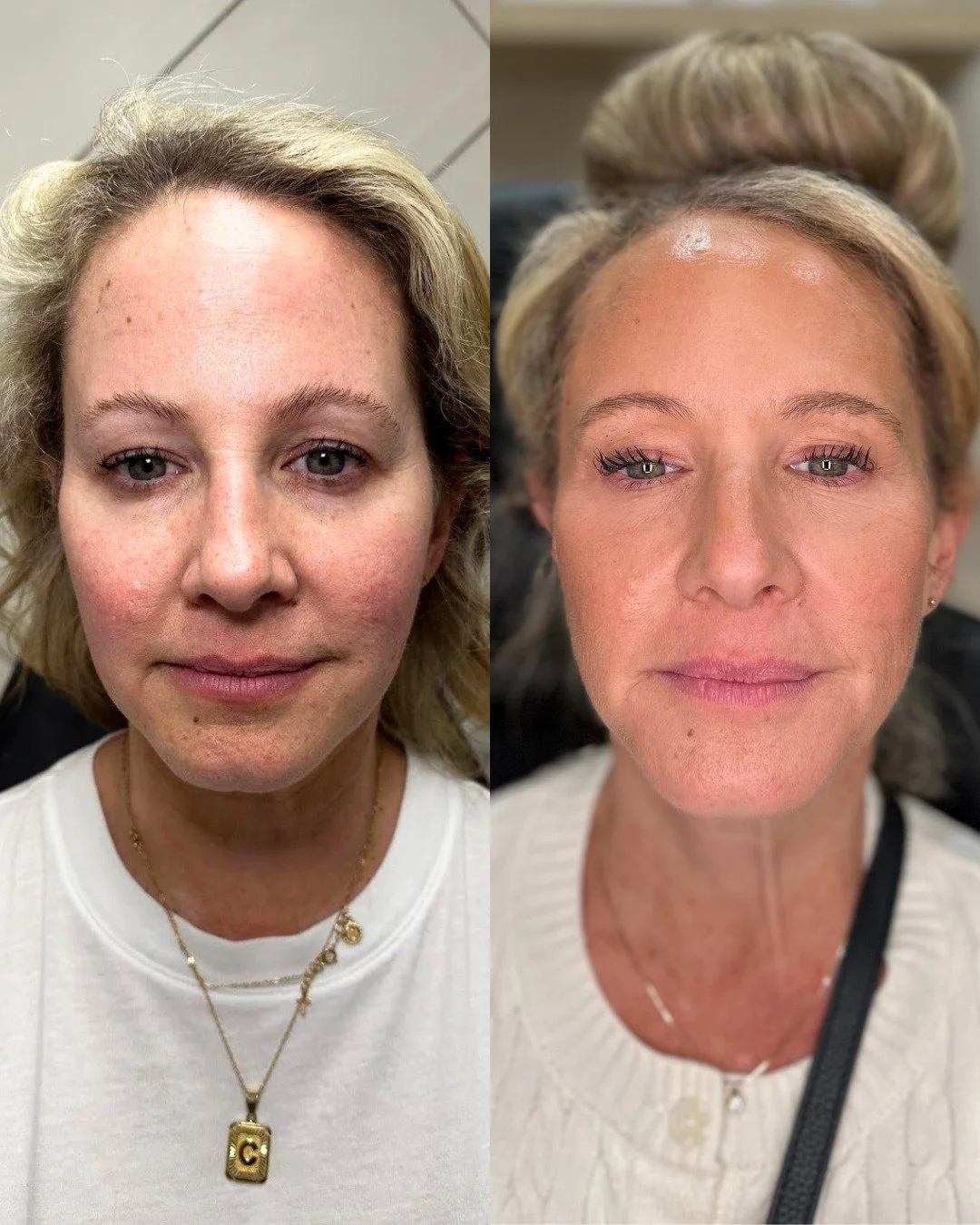 This beautiful client has been seeing Allison since May 2023! She has received Sculptra sessions, Lip filler, Cheek filler and quarterly Botox! Look at her natural transformation over the years 🤩 

Do you want to start aging backwards? Call us to st