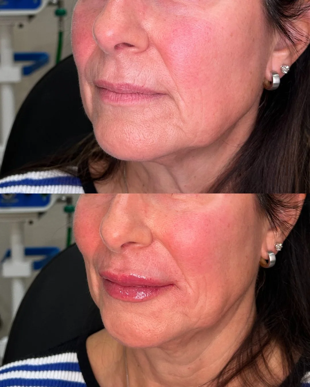 We are in love with these lips 👄

Come get your filler with us at The Glow Lab today! 

📞480-771-7202
📍The Glow Lab
  Gilbert, AZ

#gilbertmedspa #botox #lipfiller #gilbertinjectables