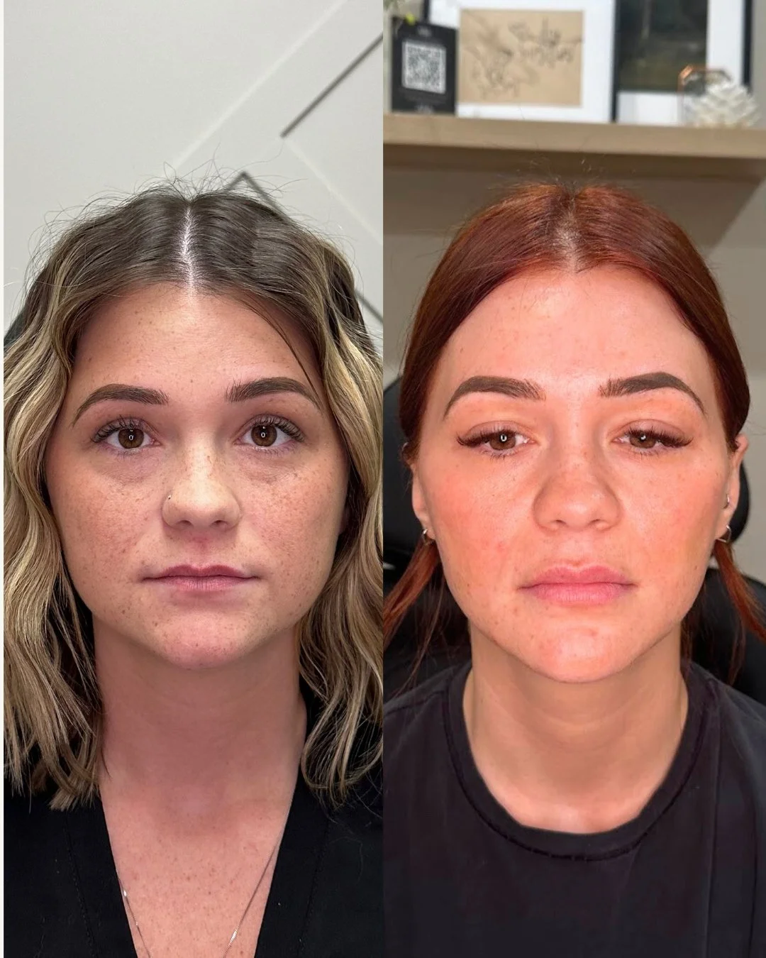 This is our beautiful go-to Glow Girl Krystian! The photo on the left is Krystian's first treatment at Glow Lab in September 2024, when she was prepping for her wedding in October 2025! In the year time span, the treatments she received were:

✨Lip F