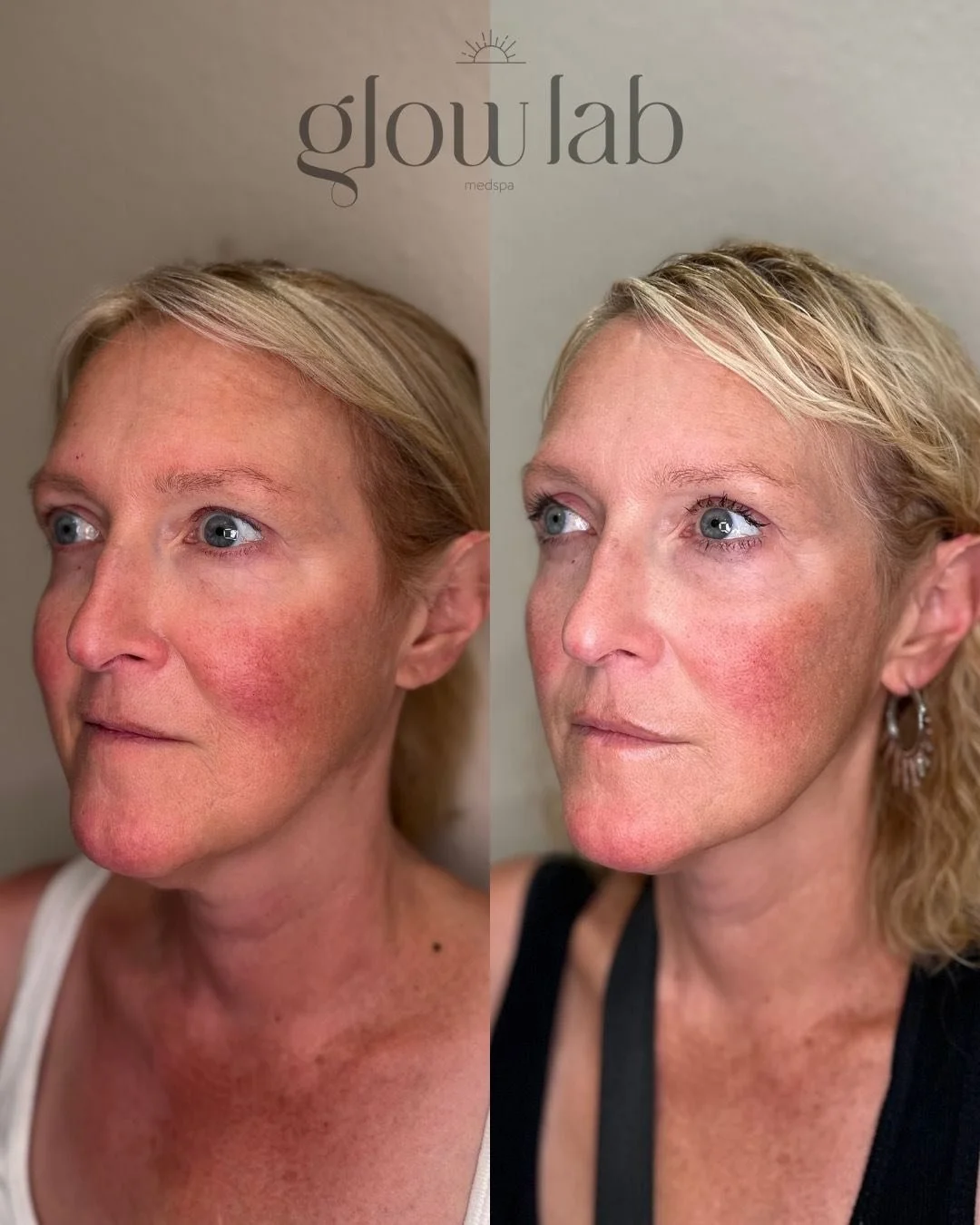 This beautiful client is glowing from the results of her series of PDO threads! Threads are dissolvable sutures that can be used to give a non-surgical lift and can also be used to restore and build support for weak, crepey areas of skin. Typically p