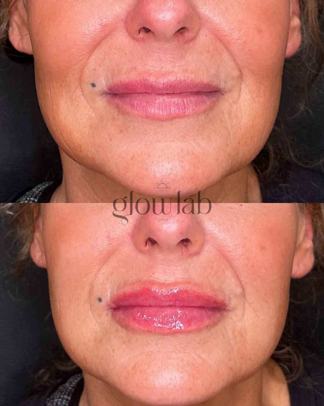 Obsessed is an understatement 🤩 

Lips are our staple service here at Glow Lab ✨ lip filler treatment focused on balance, proportion, and natural-looking results. We never over-fill, it's always customized!

📞 480-771-7202
📍 The Glow Lab

#lipfill