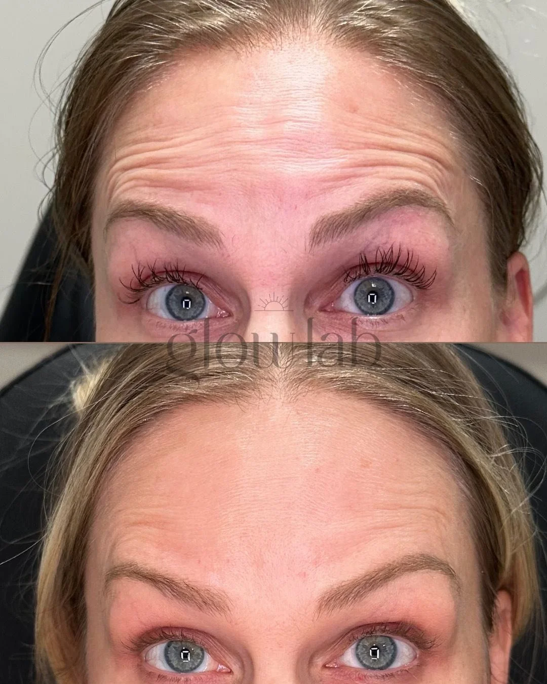 The very first time she got Botox to her most recent! Botox doesn't just relax overactive muscles, it helps prevent future wrinkles from forming 💉 

Come see us to help you turn back the clock and get your preventative treatments now!

📞 480-771-72
