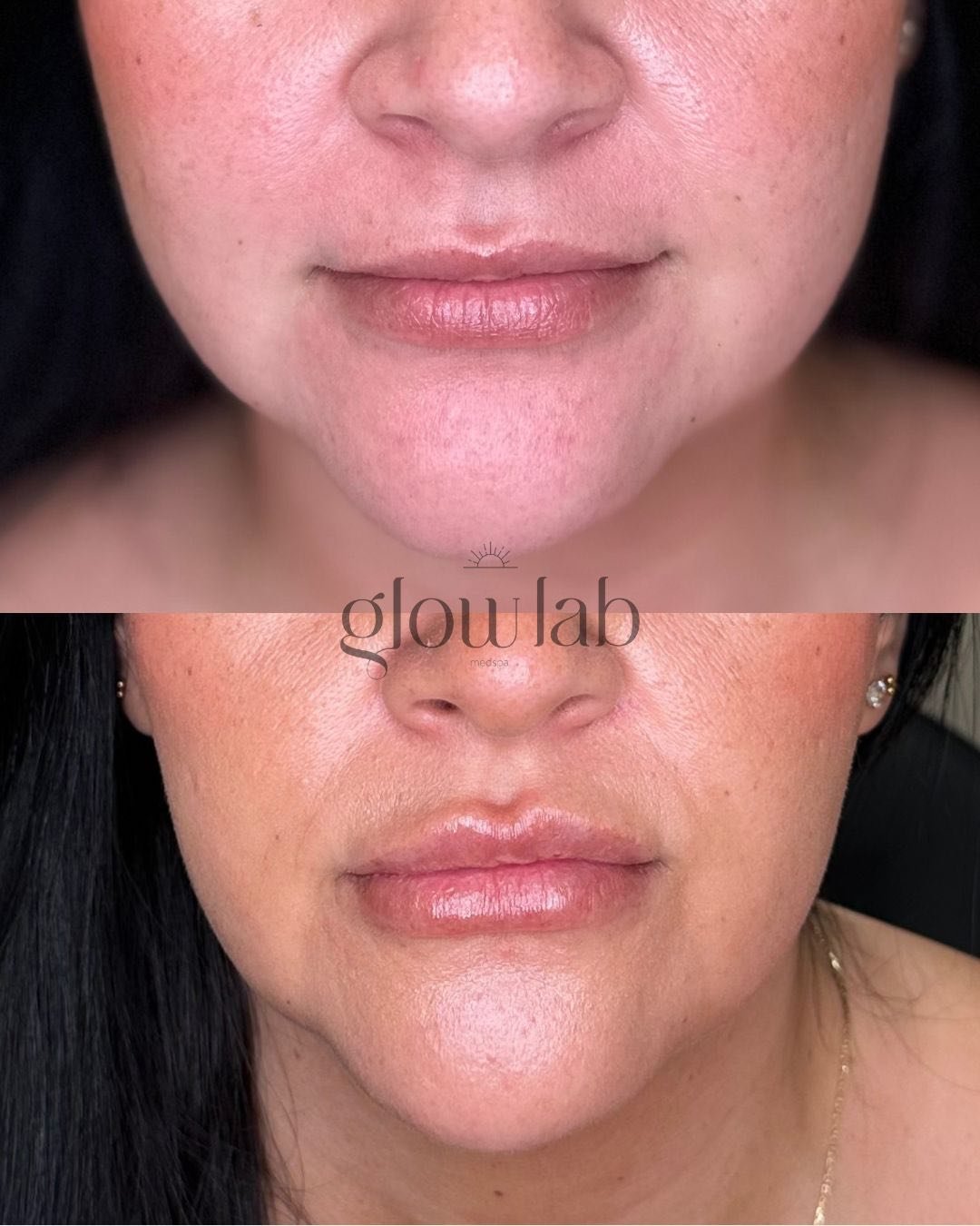 Fresh lips just in time for Valentine's Day 💋 Come get the lips you've been dreaming of! Lip filler is $100 off this month only, hurry and grab your spot!

 📞 480-771-7202
📍The Glow Lab
  Gilbert, AZ

 #lipfiller #gilbertinjectables  #gilbert #sma