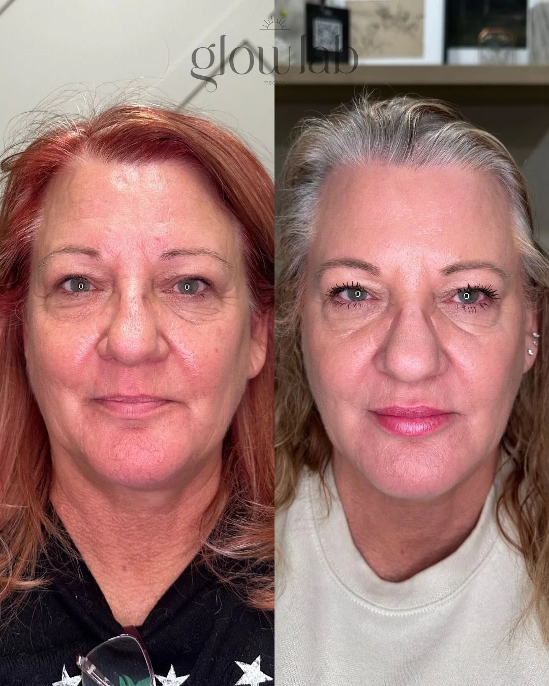 This before and after is just one example of how planning with The Glow Lab works to subtly enhance and maintain your natural beauty- without ever overdoing it. Radiesse, Jeauveau and Evolysse were used to achieve this outcome over a year span! 

Cal