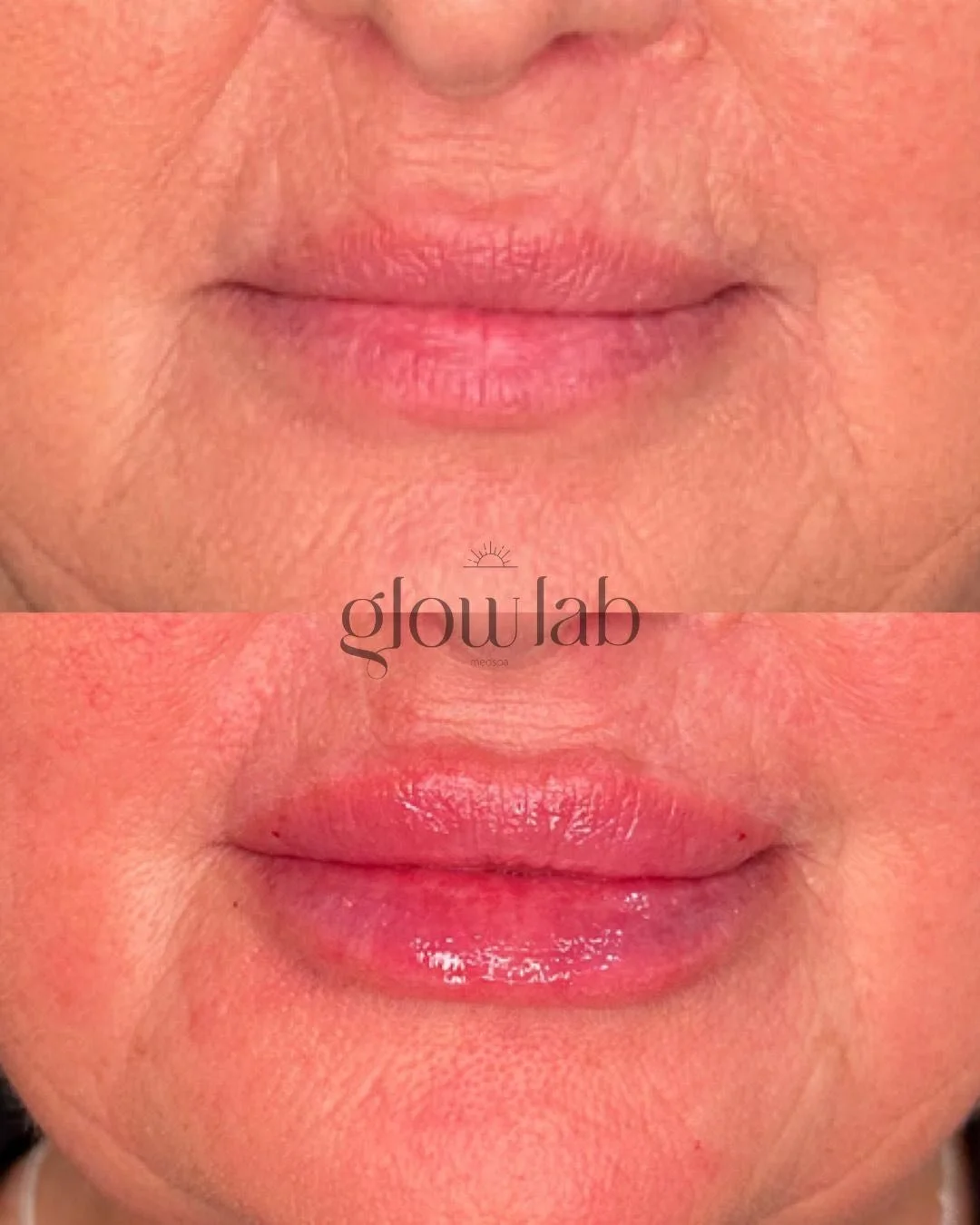 The most perfect, natural pout 👄  Lip filler doesn't just add volume, it helps hydrate and smoothen as well as softening lip lines!  8 more days left to claim our $100 off special!

📞 480-772-7202
📍 The Glow Lab
  Gilbert, AZ

 #gilbertinjectables