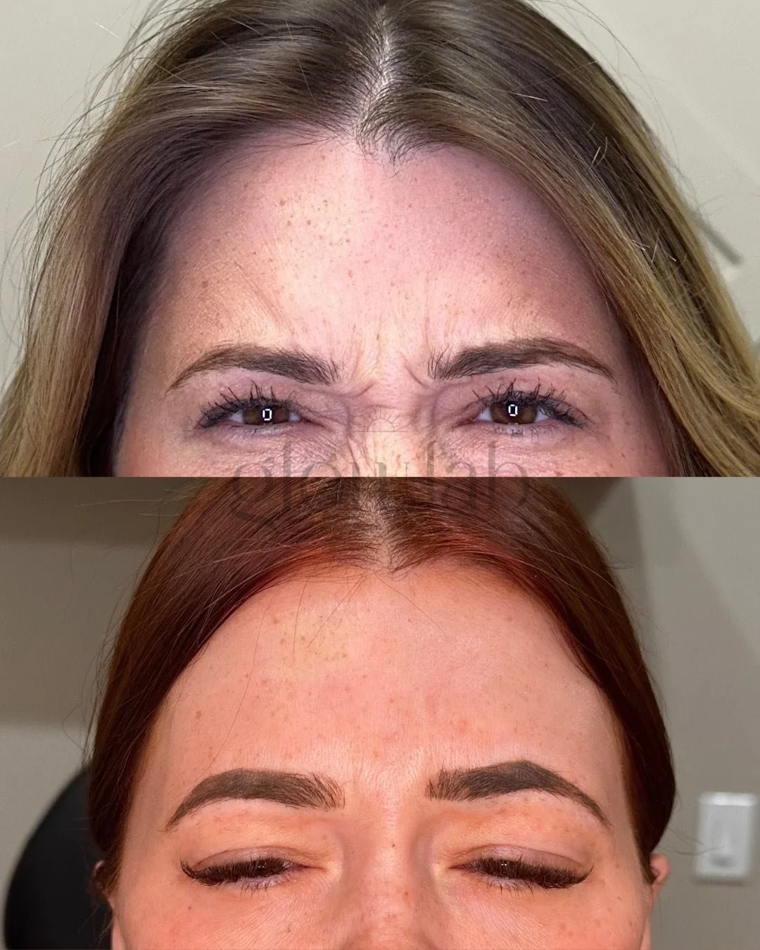 This photo shows before the first and before most recent toxin treatments! Botulinum toxin works by temporarily relaxing specific facial muscles. With consistent treatments, this can help soften dynamic lines and support long-term skin smoothness whi