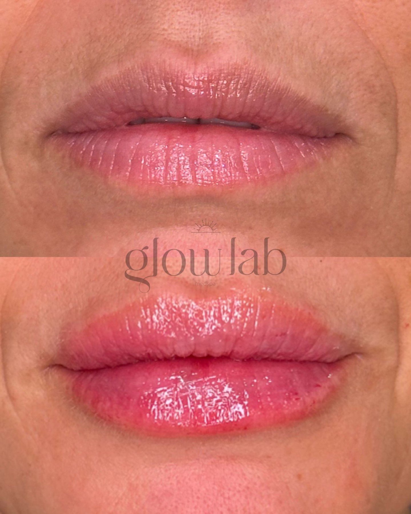 Lip filler isn&rsquo;t just about volume 👄

It&rsquo;s about:
💉Supporting the border
💉Improving symmetry
💉Restoring lost structure
💉Hydrating from within

Every lip is mapped and customized for facial harmony. Results shown immediately post-trea
