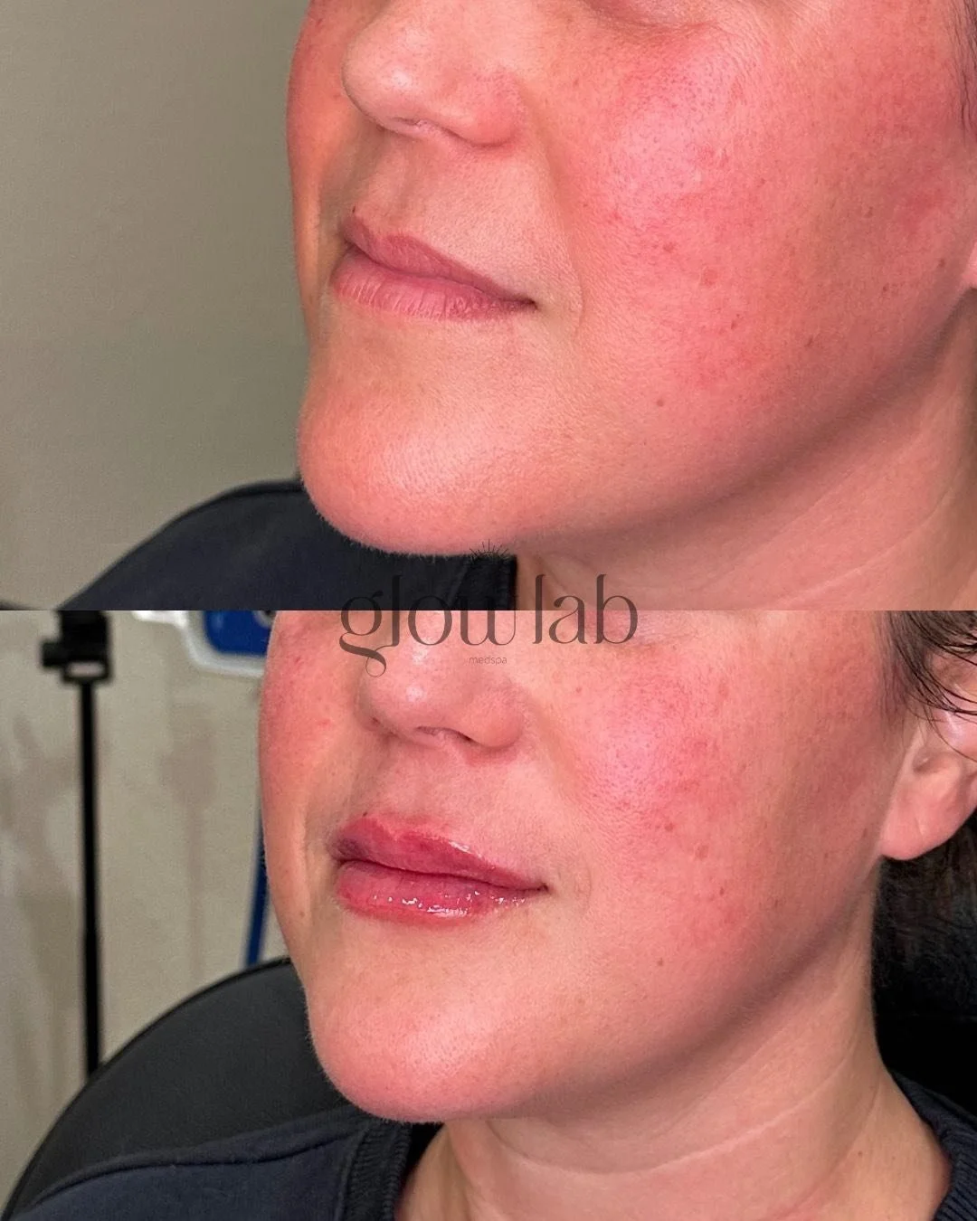 Enhanced, never overdone! We love how this little plump turned out 👄

📞 480-771-7202
📍 The Glow Lab
  Gilbert, AZ

 #gilbertinjectables #lipfiller #restylane #gilbertinjector #gilbertmedspa