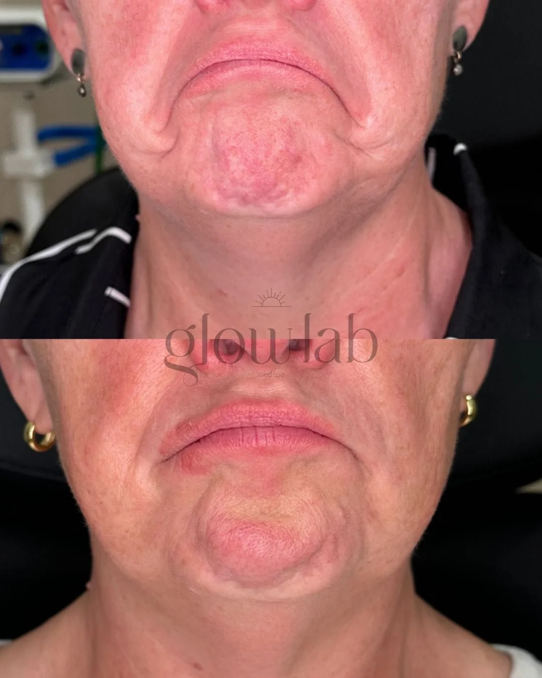 This client is new to The Glow Lab and has never gotten injectables before! We did Jeauveu in her chin and DAO
The DAOs are the muscles in the lower face that pull down the corners of the mouth, contributing to a frowning, and these results are so go