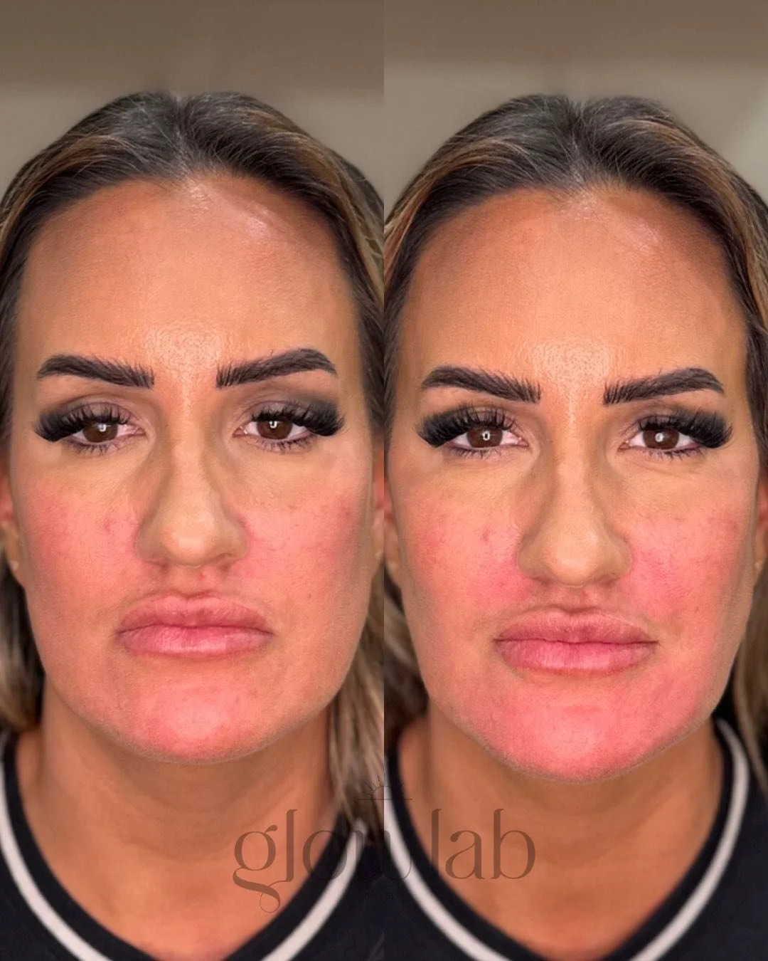 This beauty came to us for some lower face filler. We used Restylane Defyne and Refyne to help with lower face shadow, pyriform support and softening chin texture. 

Subtle, balanced, and natural movement always 💉✨ Let's get you scheduled for a cons