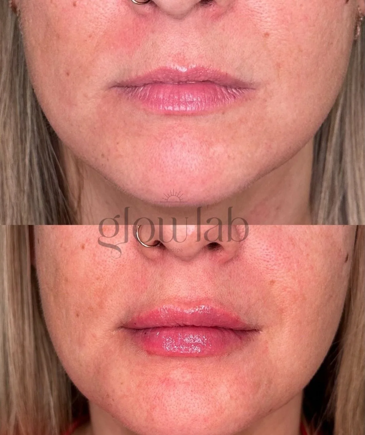 A little touch if filler goes a long way! This beauty got her lips done and they turned out just how she wanted 👄 

Come see us for the lips of your dreams! 

 #gilbert #lipfiller #gilbertaesthetics #gilbertinjector #lips