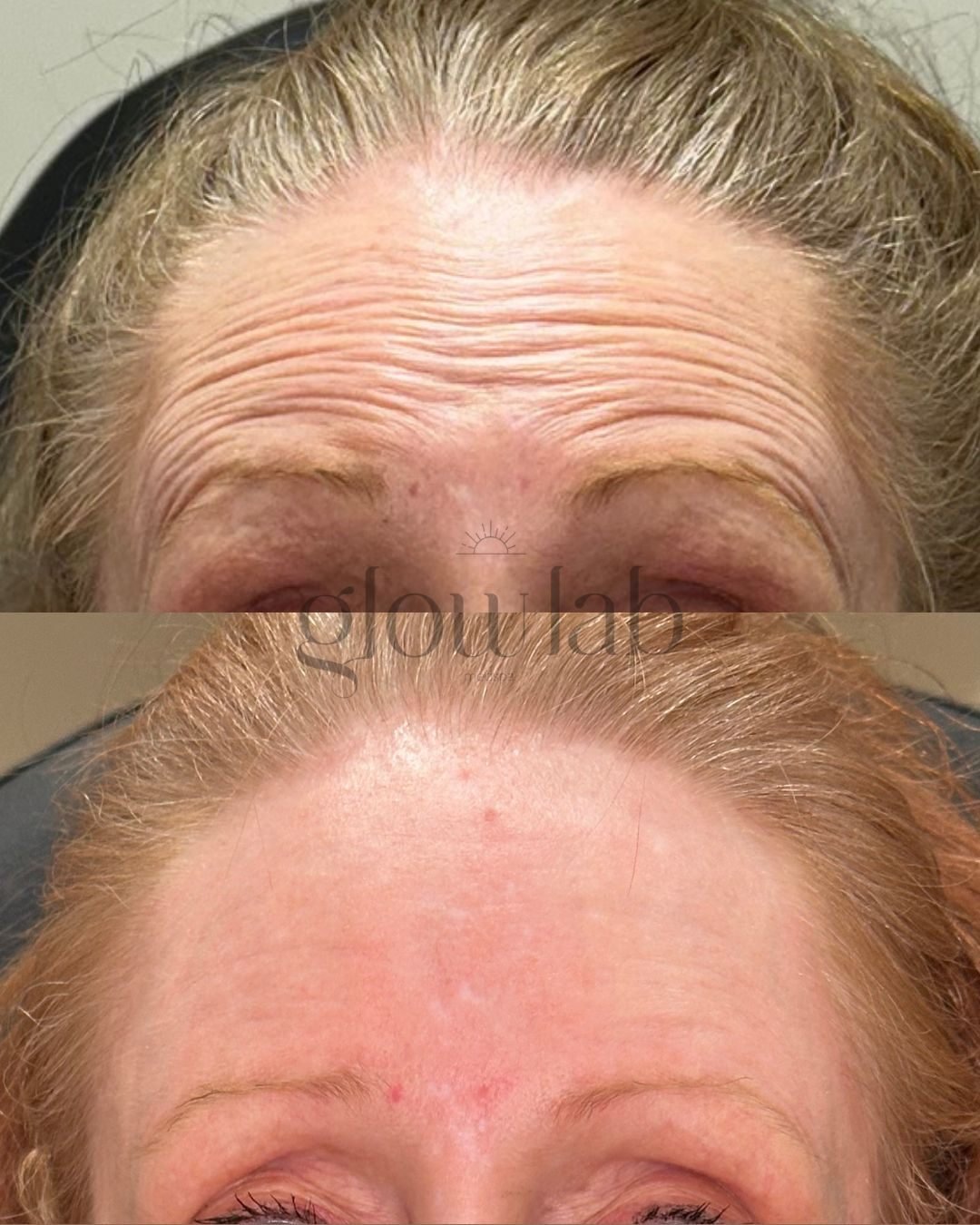 A little tox can go a long way&mdash;softening lines while keeping natural movement intact 💉 This is the first time this beauty get her Botox compared to her most recent treatment in January!

Results typically appear within 7&ndash;14 days and cont