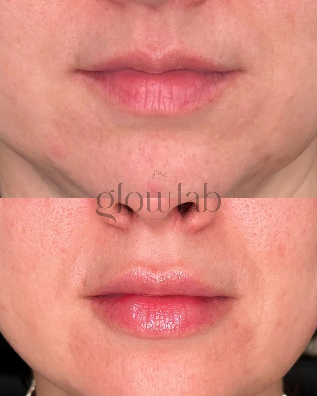 This was this client's first time seeing us and we gave her the perfect pout thats natural and defined 👄

Come see us for your perfect pout! 

📞 480-771-7202
📍 The Glow Lab
  Gilbert, AZ

 #lipfiller #gilbertinjector #gilbertinjectables #lips #gil