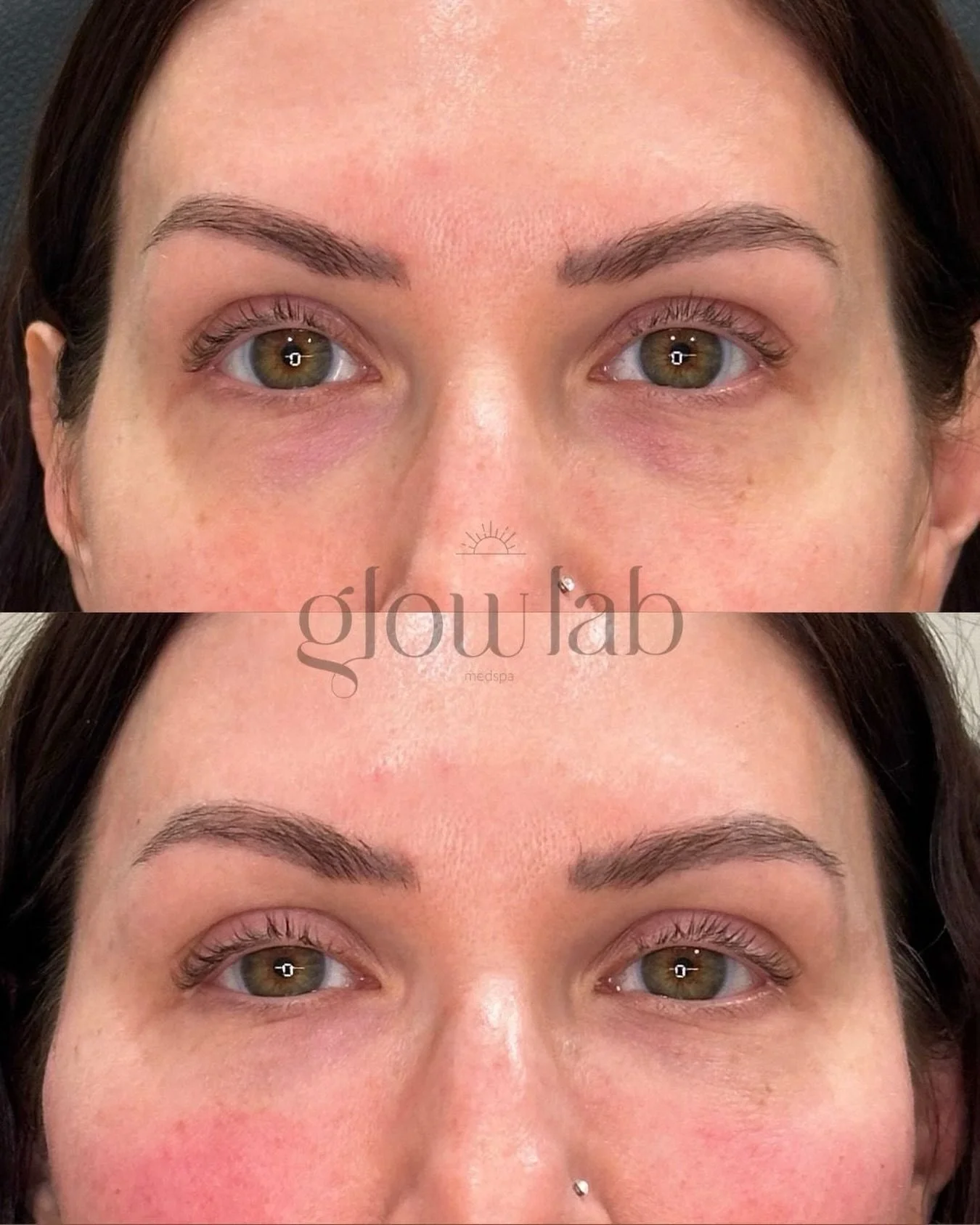 No filler. Just regeneration ✨ PRF under-eyes using your body&rsquo;s own healing power to restore what time has taken, brighter under-eyes, softened shadows, and smoother skin&mdash;without adding any volume! Results build gradually as collagen and 