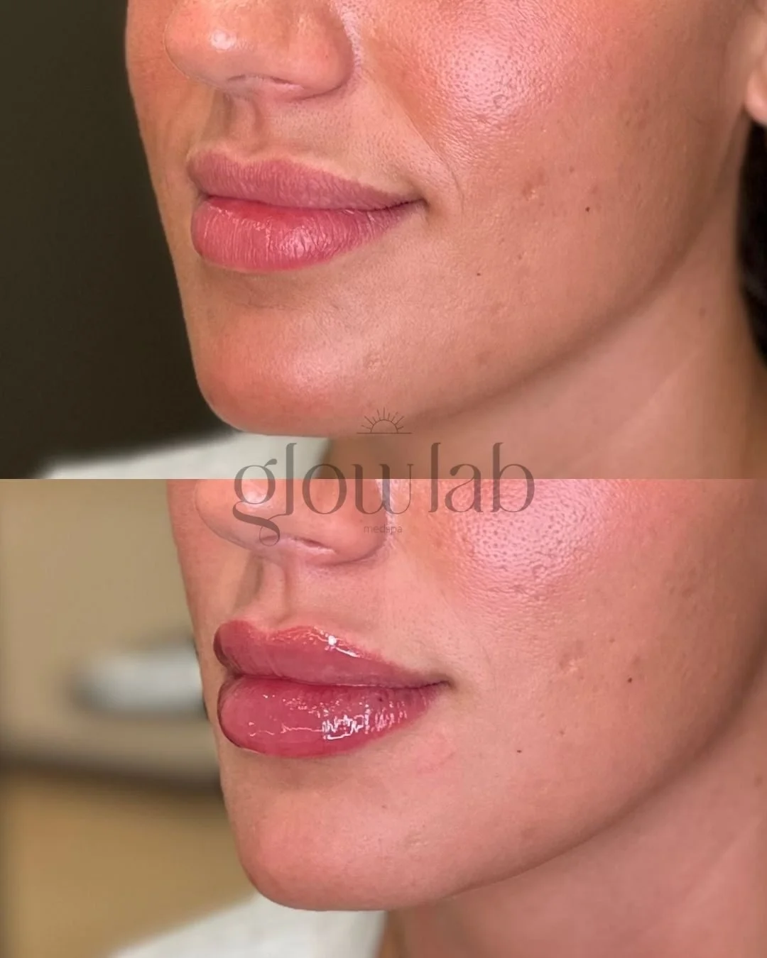 Double tap if you want your lips done 🤩💋

📞480-771-7202
📍 The Glow Lab
  Gilbert, AZ

 #lipfiller #gilbertmedspa #filler #gilbertinjectables #gilbertinjector