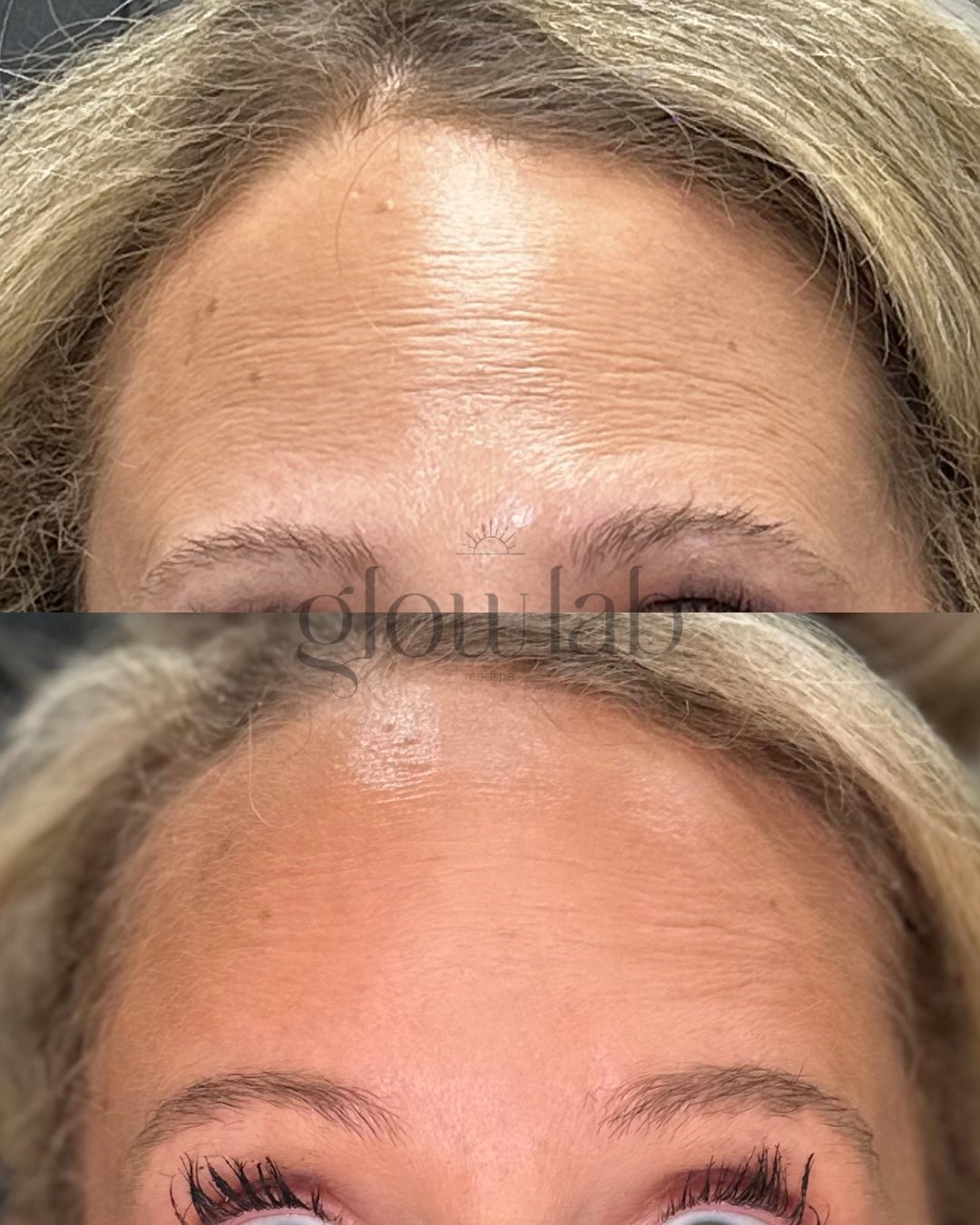 Less lines, more glow ✨

This before is from May 2023 and the after is from. her most recent treatment in April 2026. A smoother, more refreshed result is always a want 🤍

📞 480-771-7202
📍 The Glow Lab
  Gilbert, AZ

 #botox #gilbertinjector #dysp