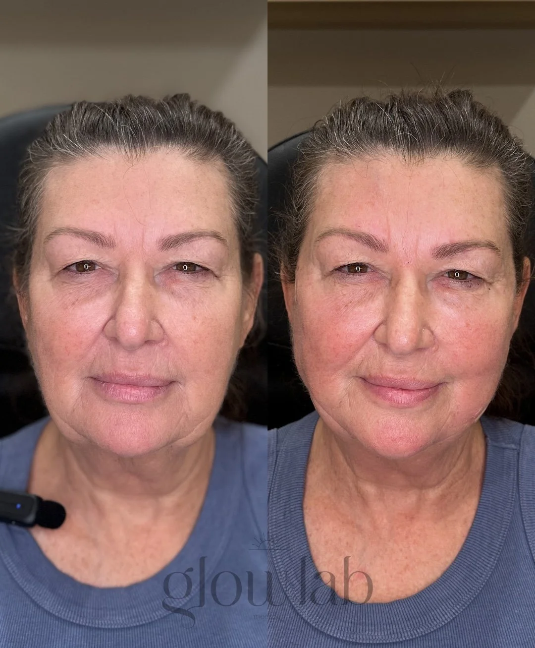This beautiful client did PDO threads paired with Botox and the results are beautiful 🤩 

Threads are effective for softening the jawline, improving lower face laxity, and supporting early jowl formation for a beautiful rejuvenated look!

📞 480-771
