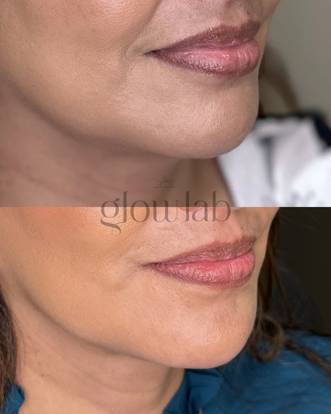 This beauty came to glow and she did ✨

We gave her more definition and volume in her chin. Often overlooked, the chin can do wonders for balancing the lower face, improving your profile, and supporting to reduce jowling! Let's help you improve your 