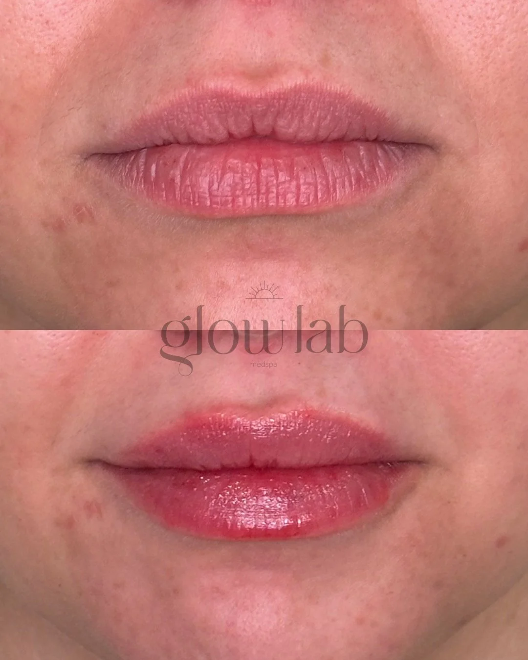 Beautiful lip refresh for a beautiful client! 

Lip filler can do a lot more than just make lips &ldquo;bigger&rdquo;&mdash;when it&rsquo;s done well, it&rsquo;s about balance, shape, and subtle enhancement. The biggest benefits are:

✨Boosts Hydrati