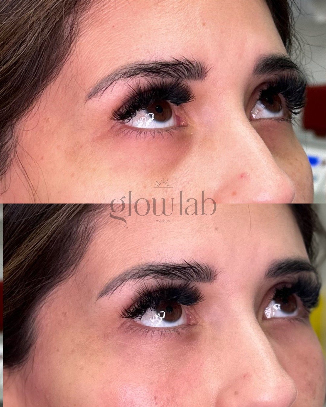 Goodbye undereye darkness 👋🏼 👋🏼

This magic treatment is PRF Gel known for using natural growth factors found in Platelet Rich Fibrin. This approach uses your own blood to create a filler-like gel that can be injected into the skin to enhance vol