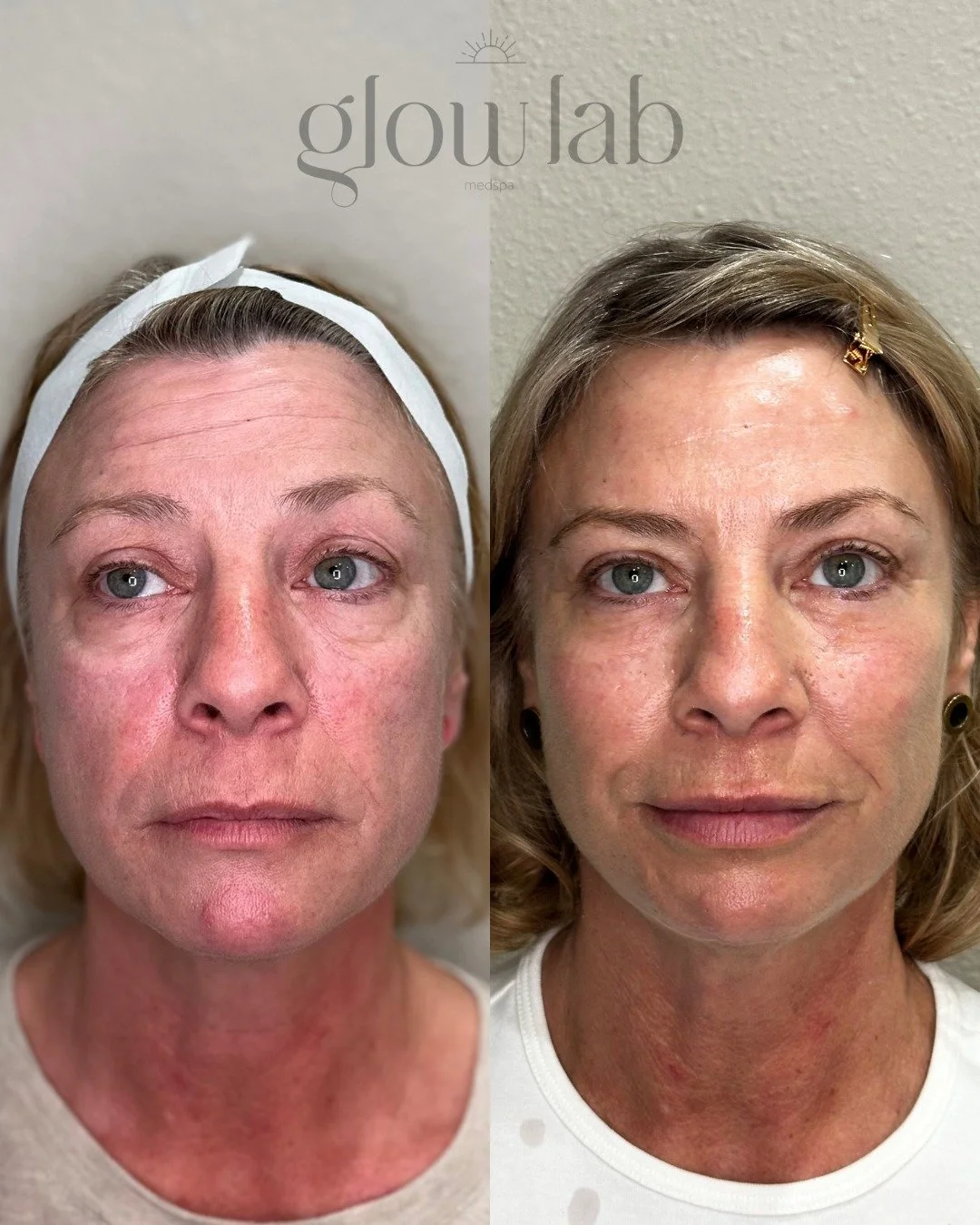 This GORGEOUS client did full balancing with @allisonstjohn_np . She did:
✨ Tox
✨ 2 treatments of undereye biostimulators
✨ 2 treatments of Radiesse
✨ Lip filler 
✨ 2 treatments of microneedling with PDRN booster

Come age backwards with us! Book you