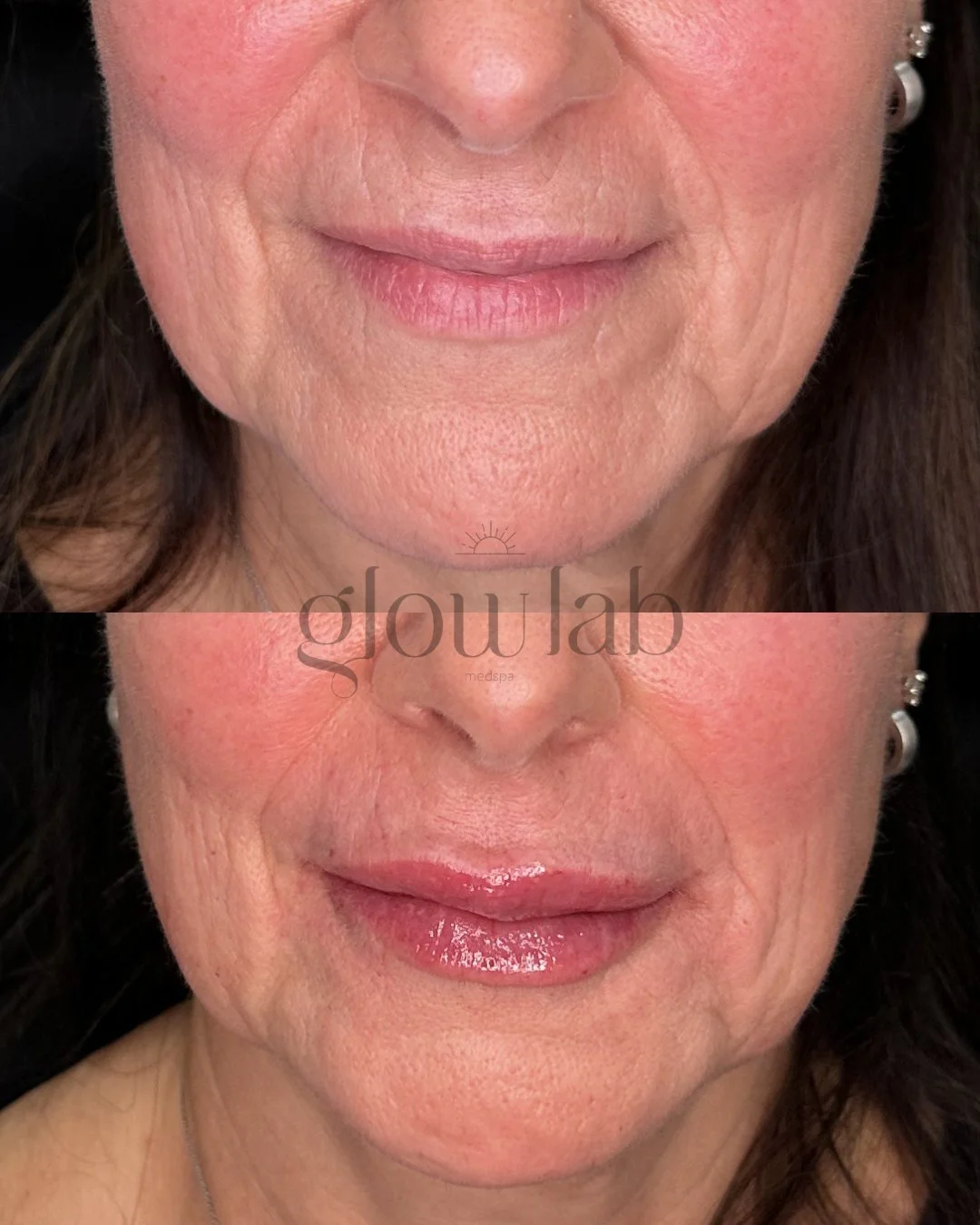 Defined. Hydrated. Enhanced. 

Can you tell we love doing lips 🤩

 #gilbertinjector #filler #gilbertinjectables #skincare #gilbert