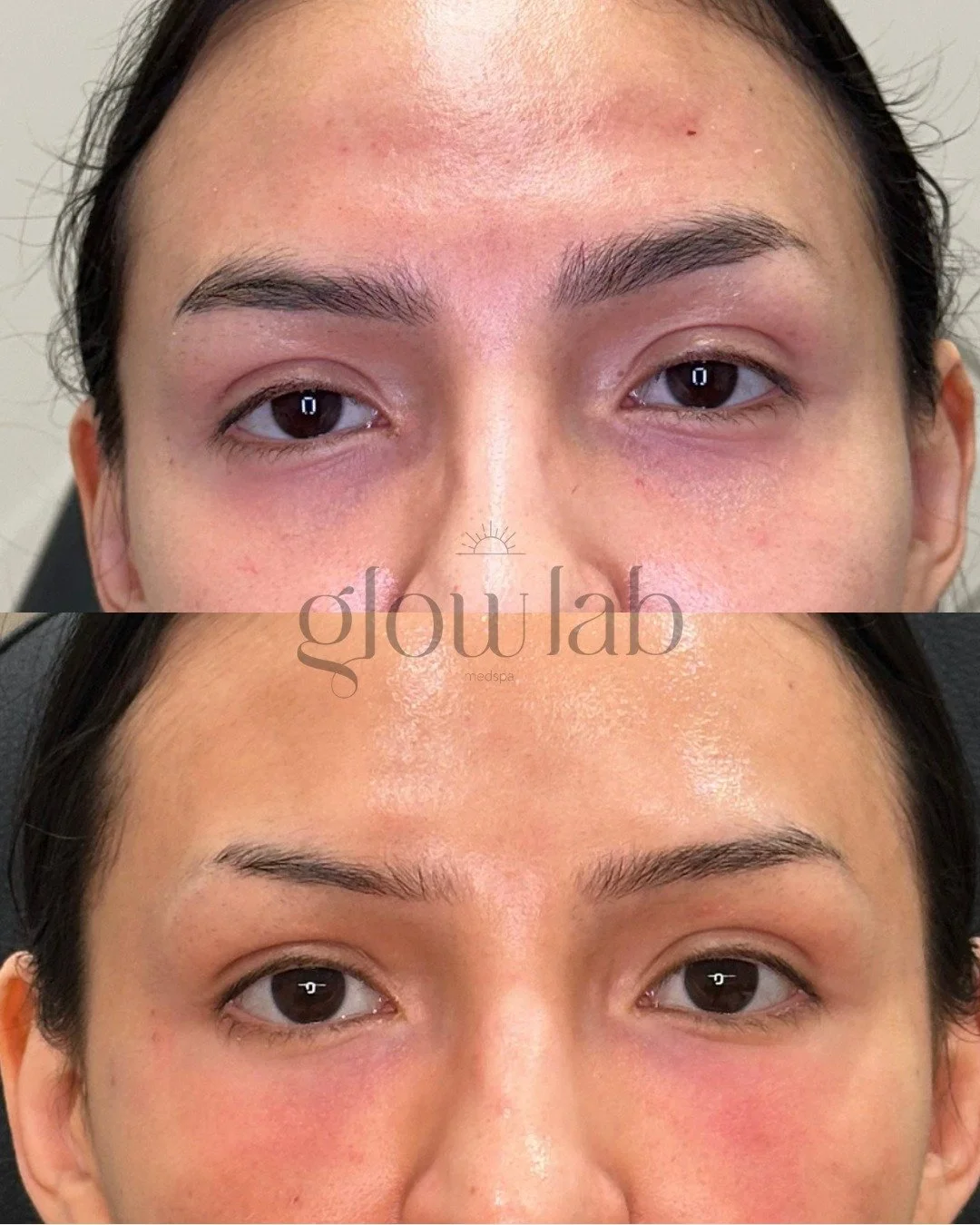 The magic of ✨PRF Gel✨ 

This procedure uses your own blood components, making it a safe and natural way to boost your beauty, combining the power of PRF with a gel matrix for sustained results, giving your skin that fresh, youthful glow!

Book your 