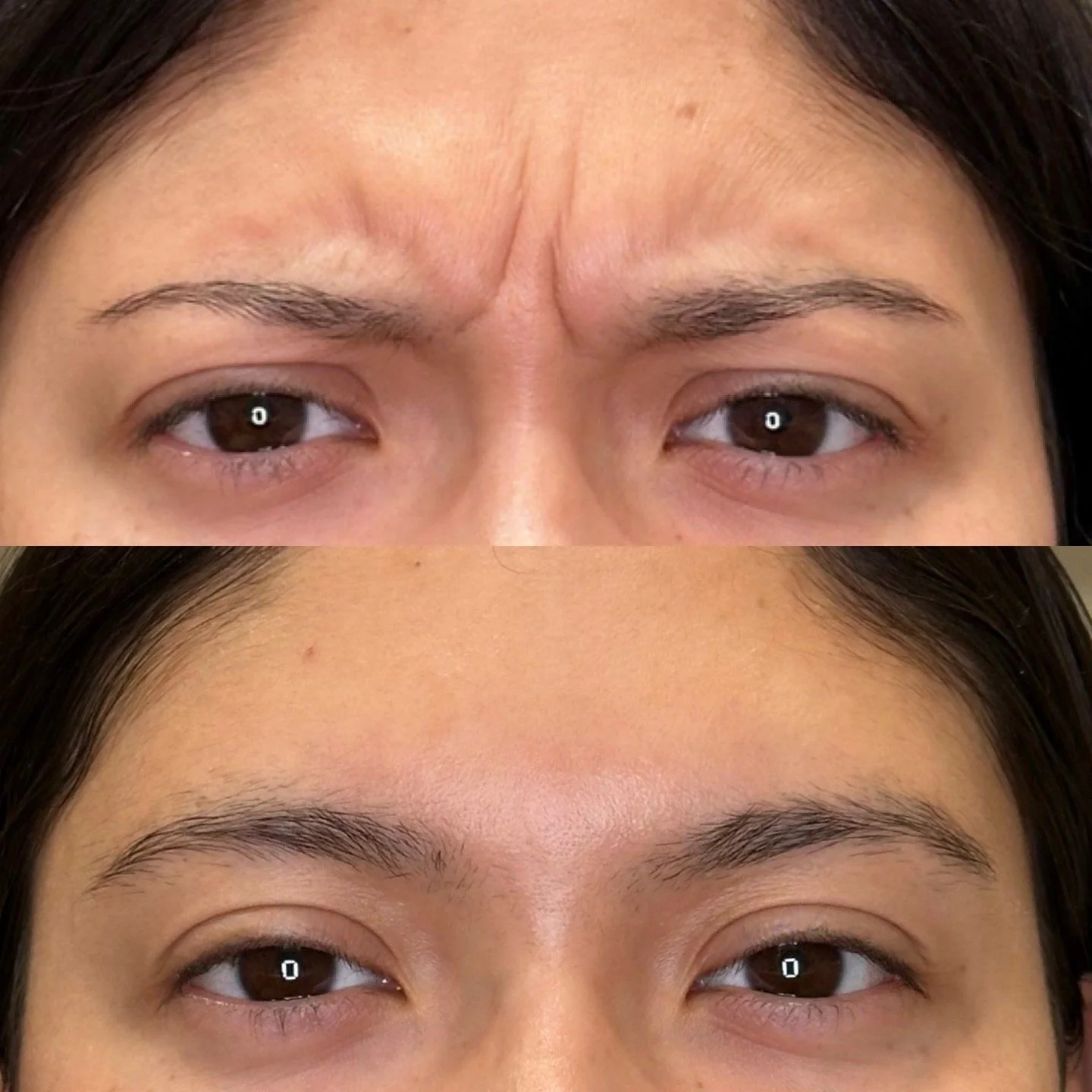 Beautiful work by @myinjectorsam 🤩

Did you know Sam is taking both weightloss patients as well as TOX patients! We are so excited for her that we are giving YOU $1 off per unit of tox when you book with Sam. A deal you can't miss. Call, text or boo