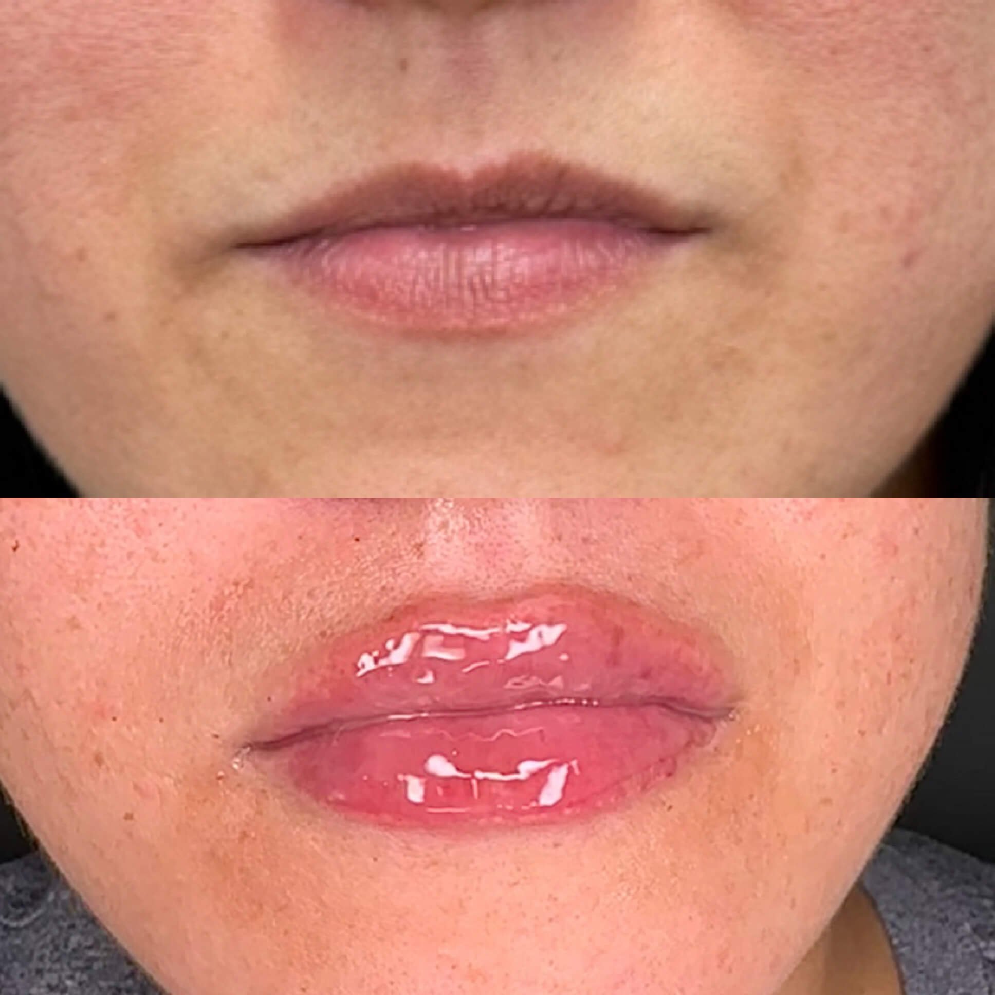  Restylane lip filler before and after 