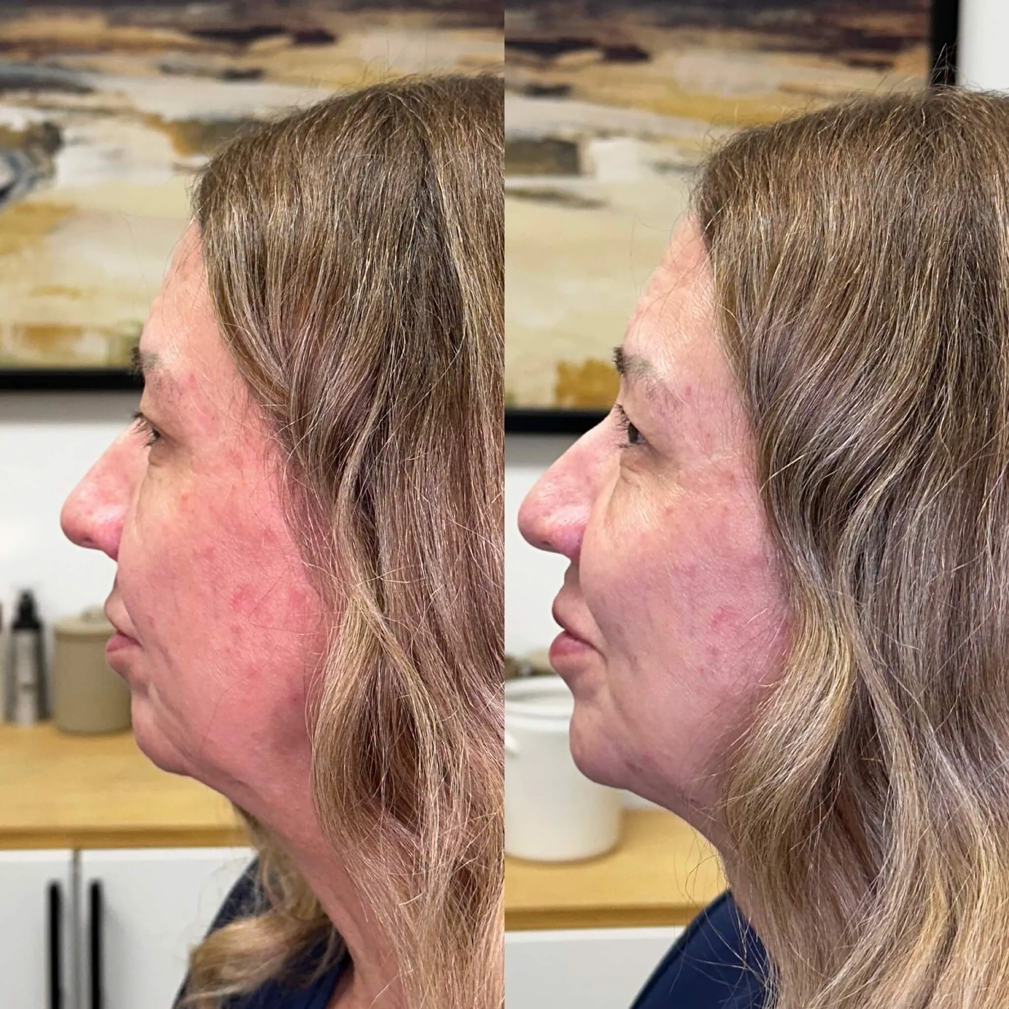  Restylane cheek filler 