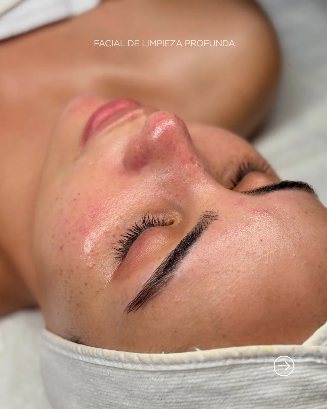 Antes + Despu&eacute;s de Facial de Limpieza Profunda. 

Un tratamiento de 1 hora que:
✨ Purifica en profundidad
✨ Minimiza poros
✨ Mejora textura
✨ Hidrata y nutre

📲 Agenda tu cita via whatsapp o el link de nuestro perfil
📞(664) 547-1459
📍Tijuan
