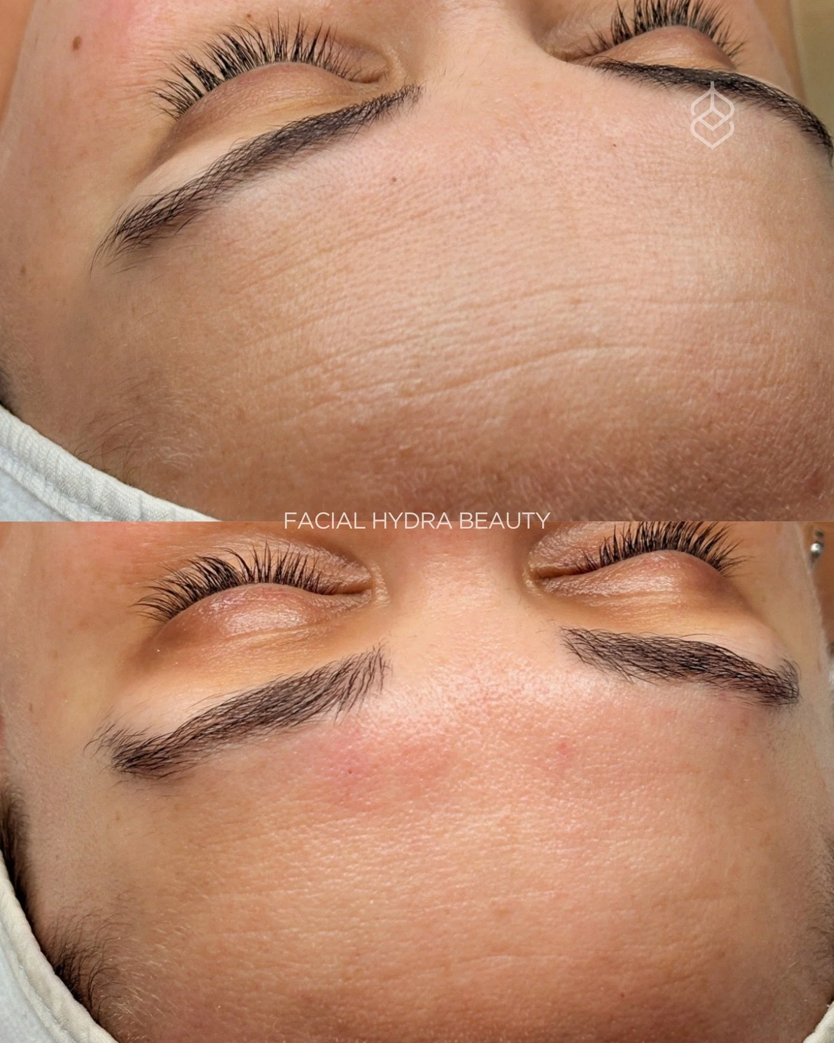 Before &amp; After 🩷 Facial con Hydra Beauty

Una piel m&aacute;s limpia, hidratada y con mejor textura desde la primera sesi&oacute;n.

HydraBeauty ayuda a limpiar en profundidad, remover impurezas y aportar hidrataci&oacute;n sin agredir la piel. 