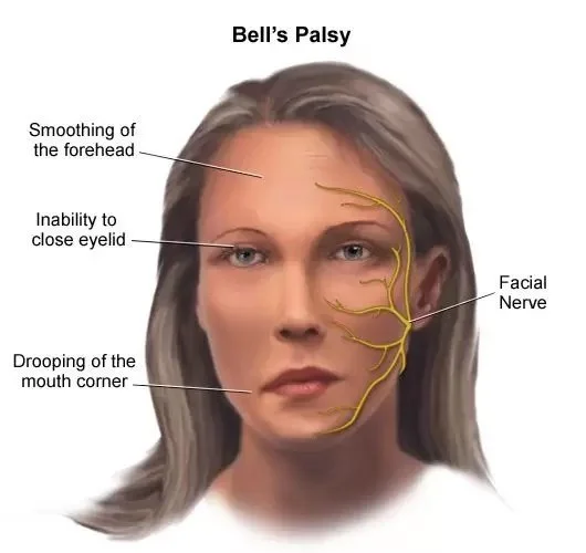 Bell's Palsy Case Study: A 55-Year-Old Female